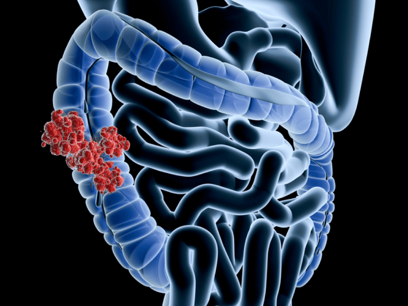 Kolon xərçəngi Səbəbləri