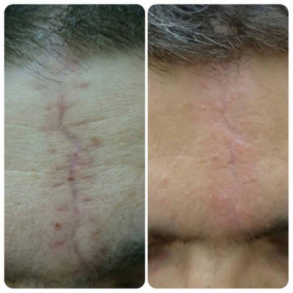 Çapıqların müalicəsi