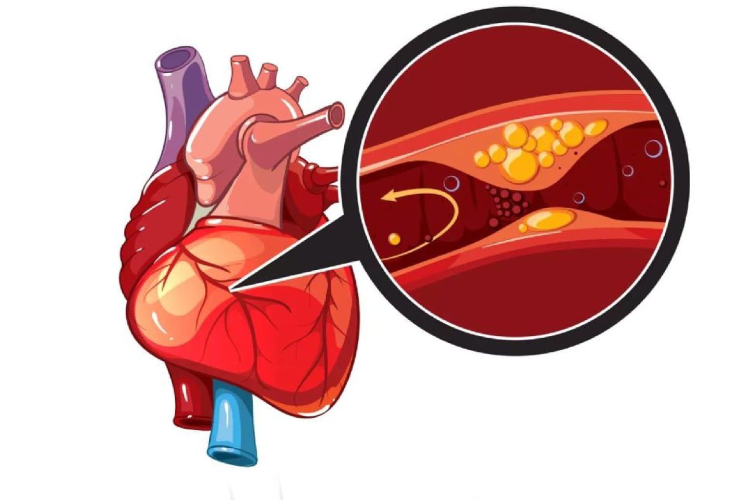 Koronar Arteriya Xəstəliyi
