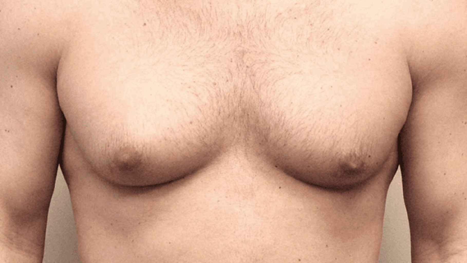 Kişilərdə döş böyüməsi (JİNEKOMASTİYA)