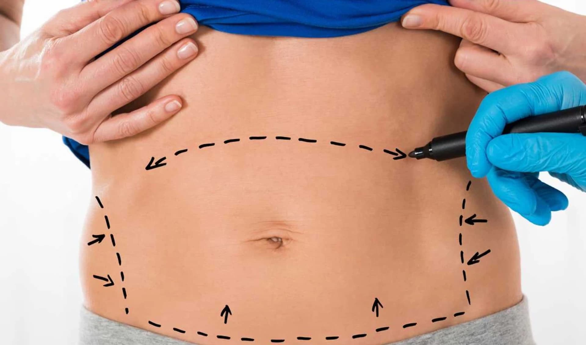 Abdominoplastika: Qarın Estetiği və Funksional Korreksiya Cərrahiyyəsi