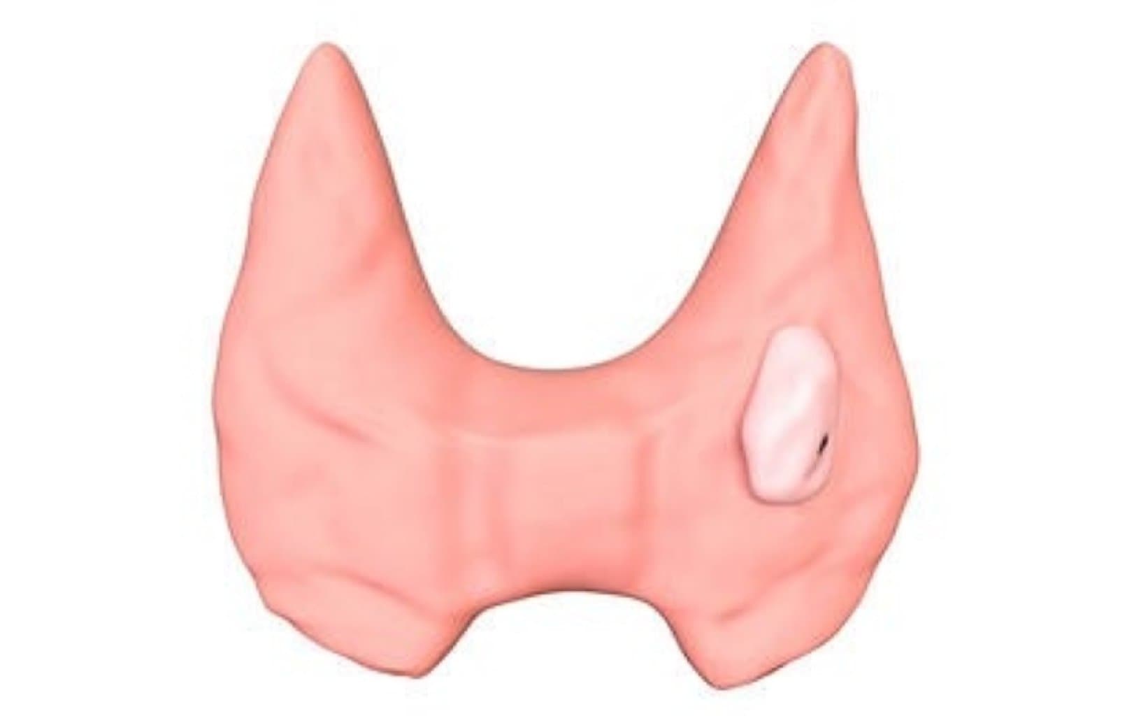 Tiroid neoplaziyaları