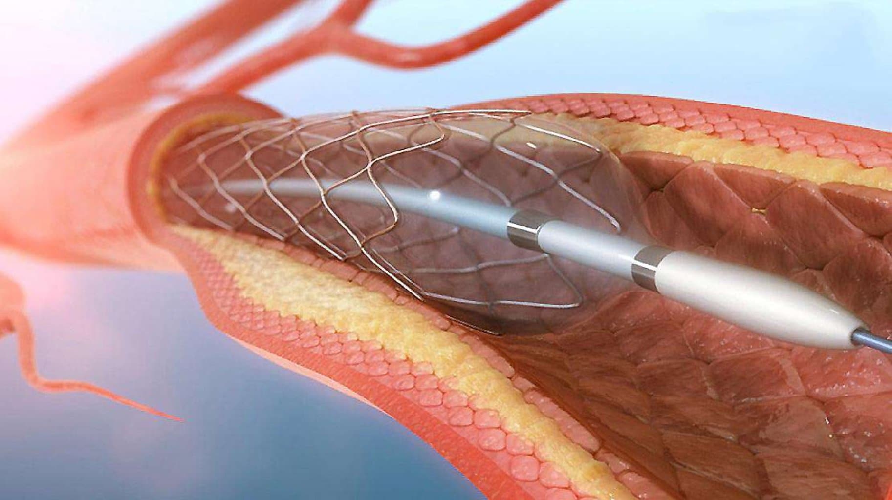 Koronar angioplastika: Ürək damarlarının yenidən açılması
