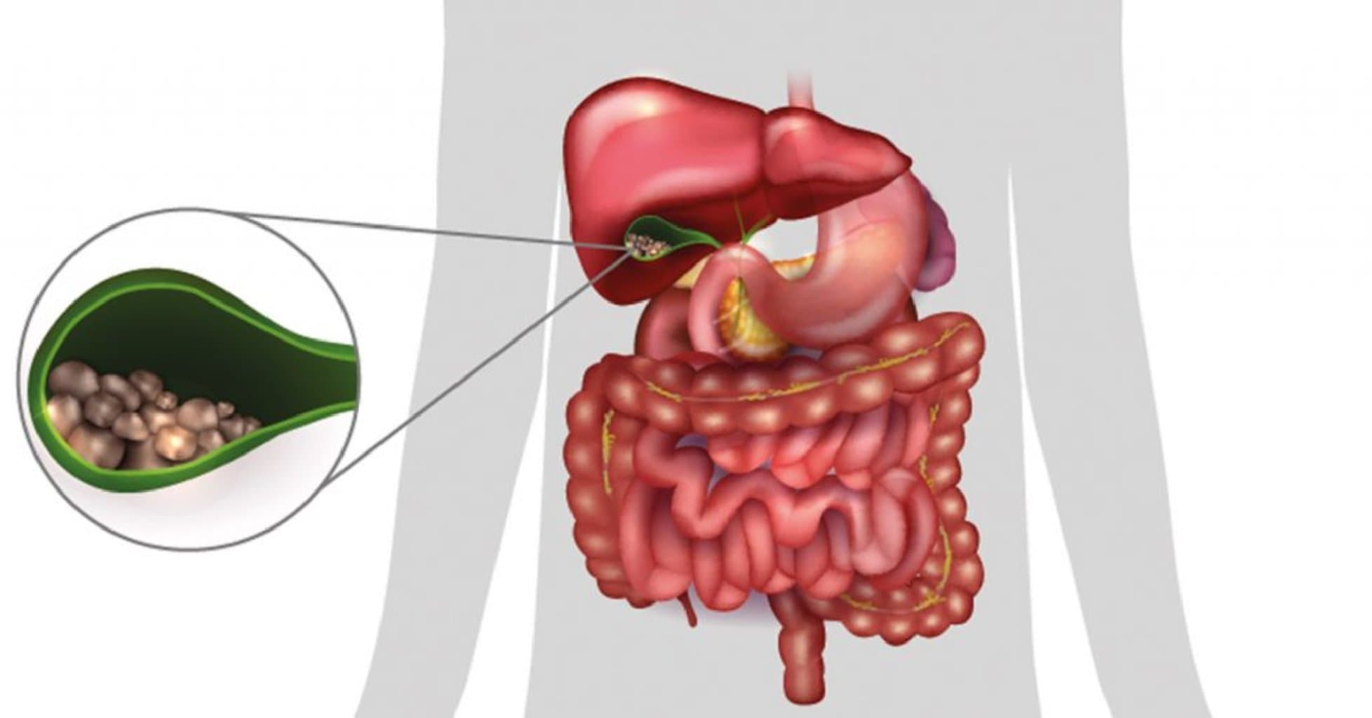 Qaraciyər və öd kisəsi xəstəlikləri