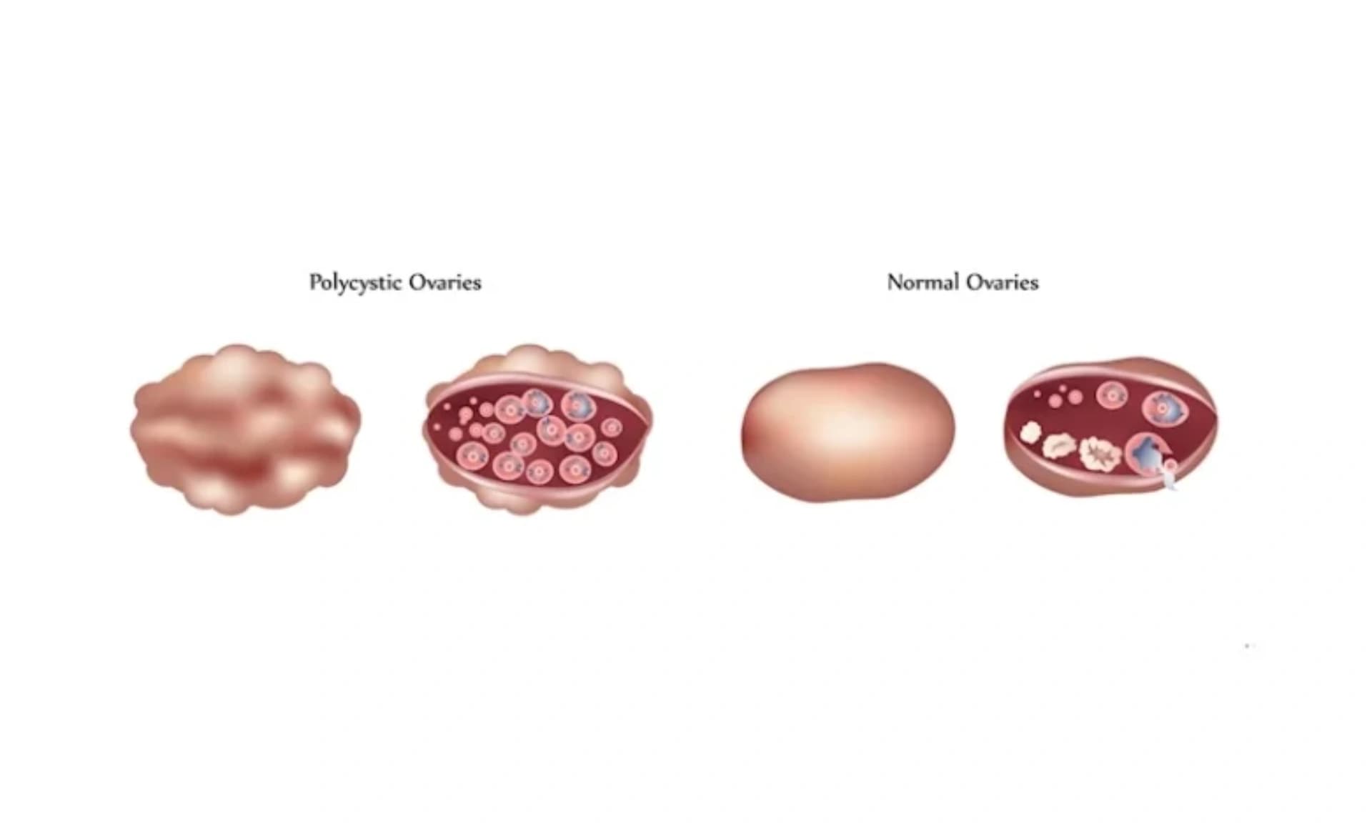 Polikistik Yumurtalıq Sindromu (PCOS): Simptomlar, Səbəblər və Müalicə