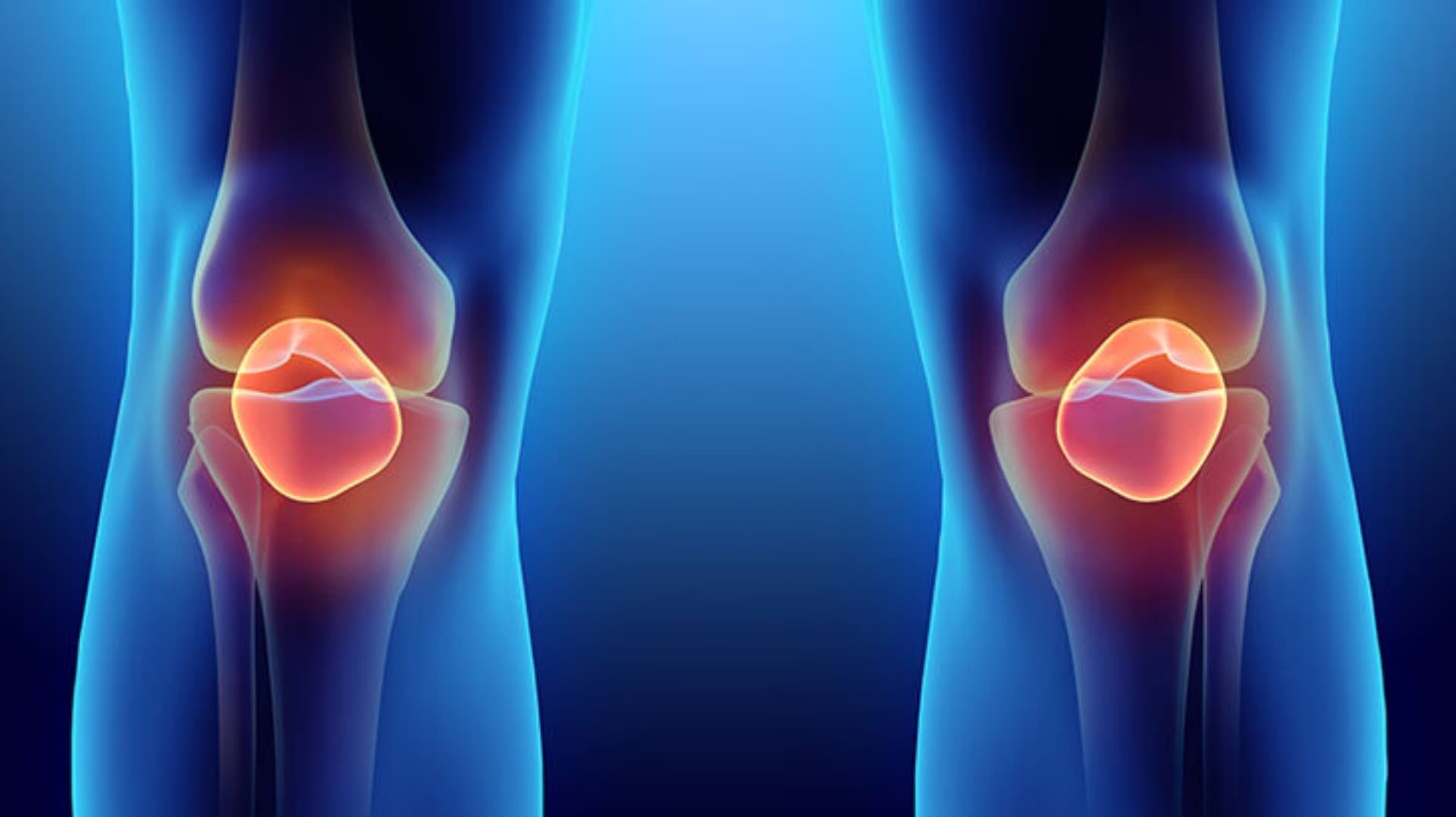 Artrit: nədir, simptomları və müalicəsi