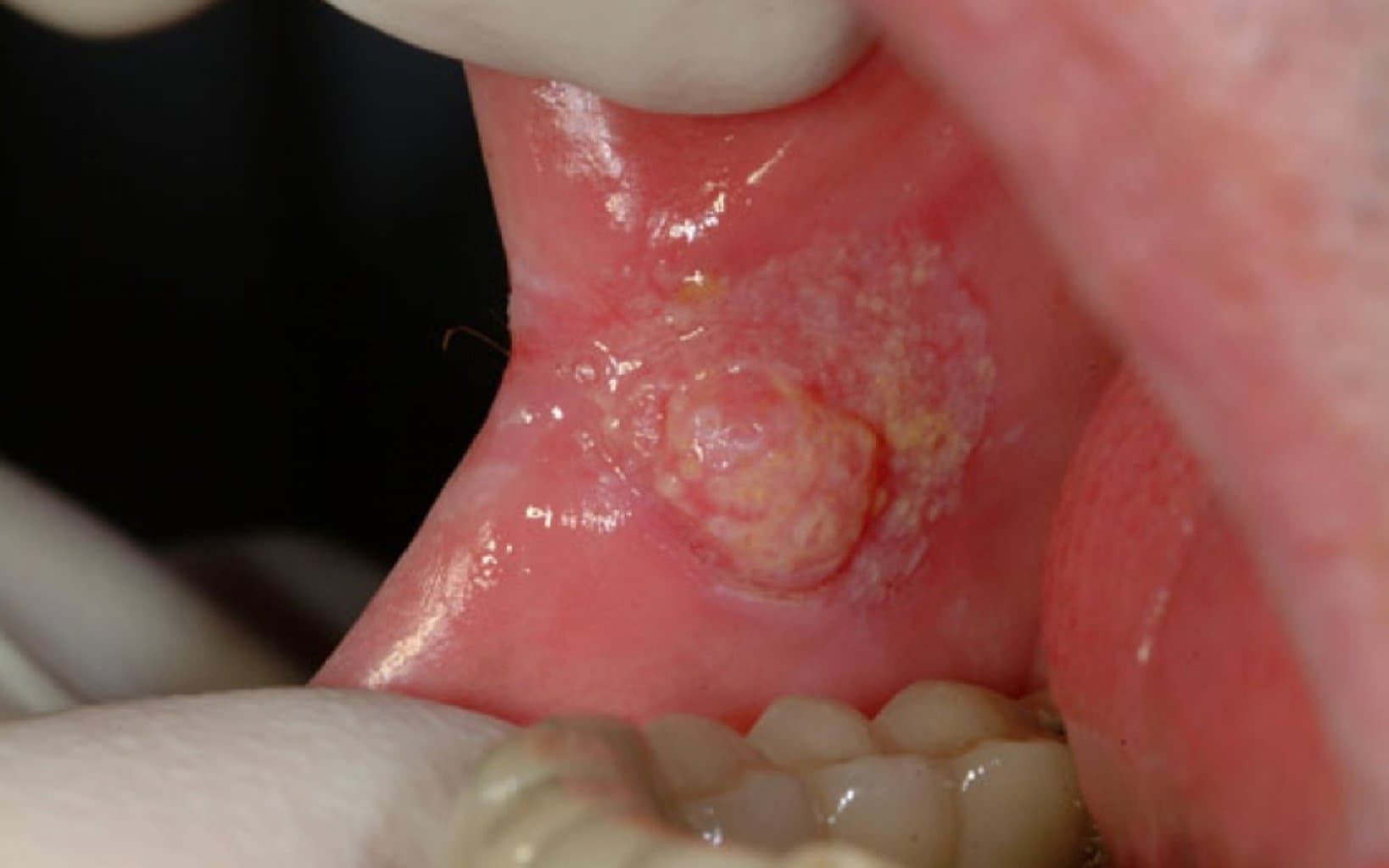 Ağız Xərçəngi: Simptomlar, Səbəblər və Müalicə Metodları