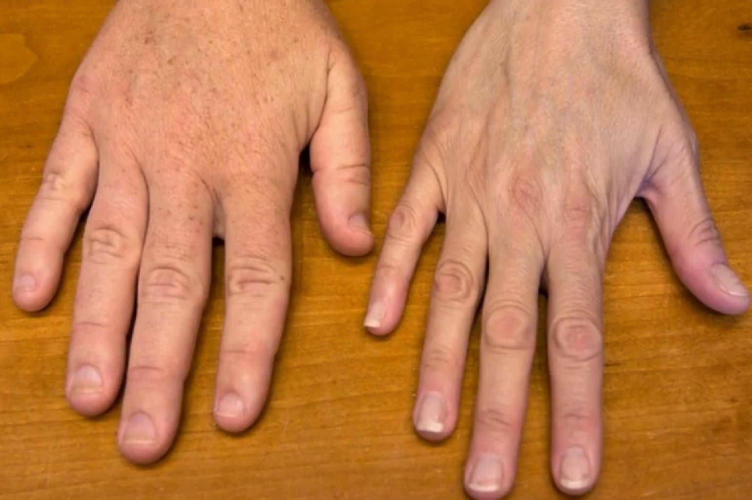 Böyümə hormonu (GH) yüksəkliyi (AKROMEGALİ)