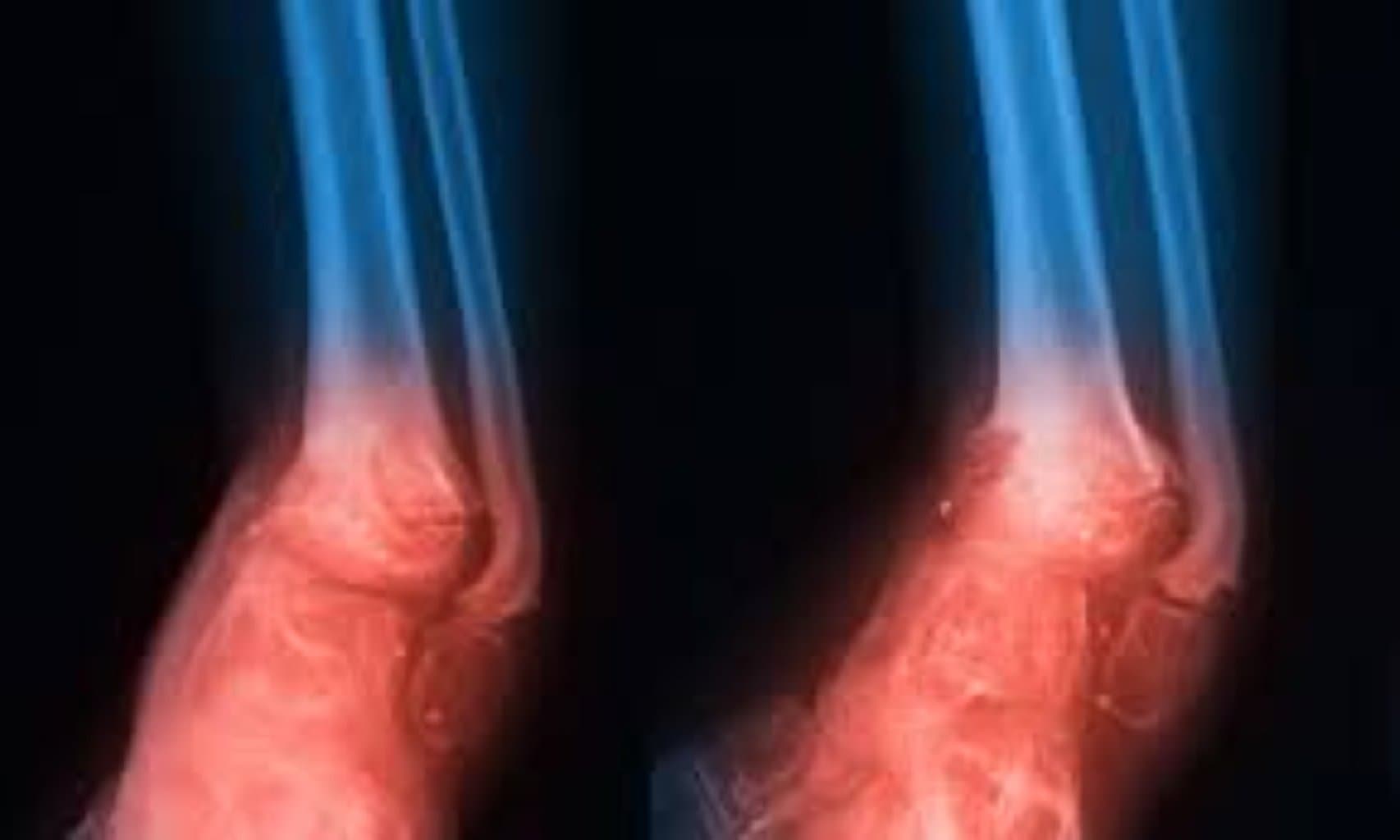 Osteomielitlərin cərrahi və konservativ müalicəsi