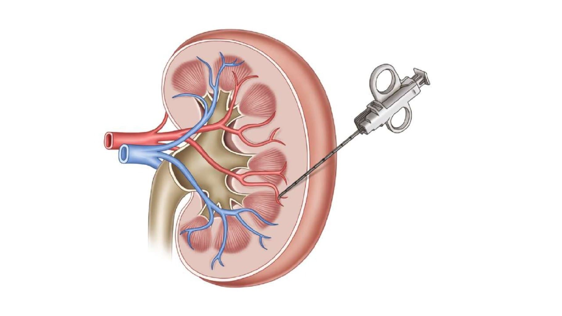 Kəskin və xroniki böyrək zədələnmələri