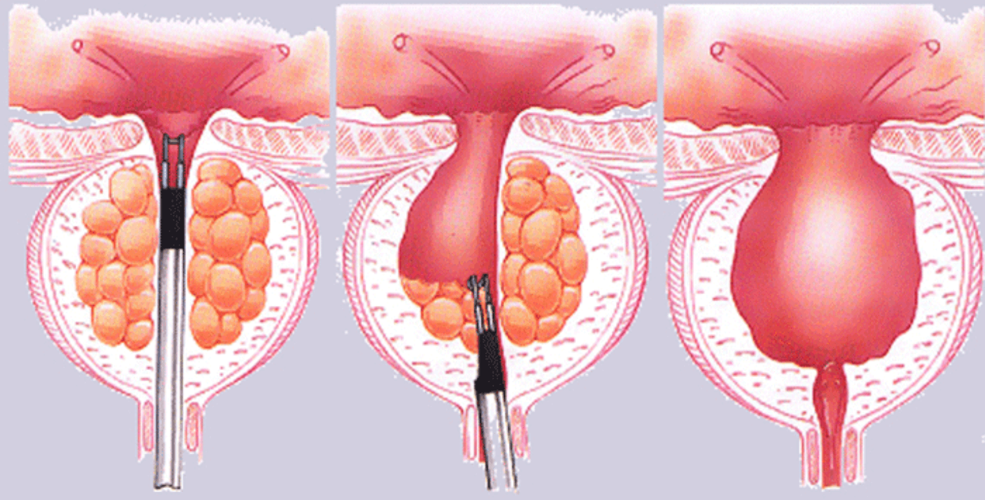 Prostat vəzi törəmələri