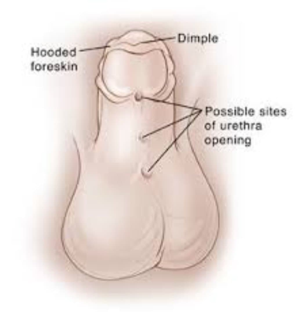 Sünnet Derisinin Şişmesi və ya Qızarması: Səbəbləri, Simptomları və Müalicə Yolları