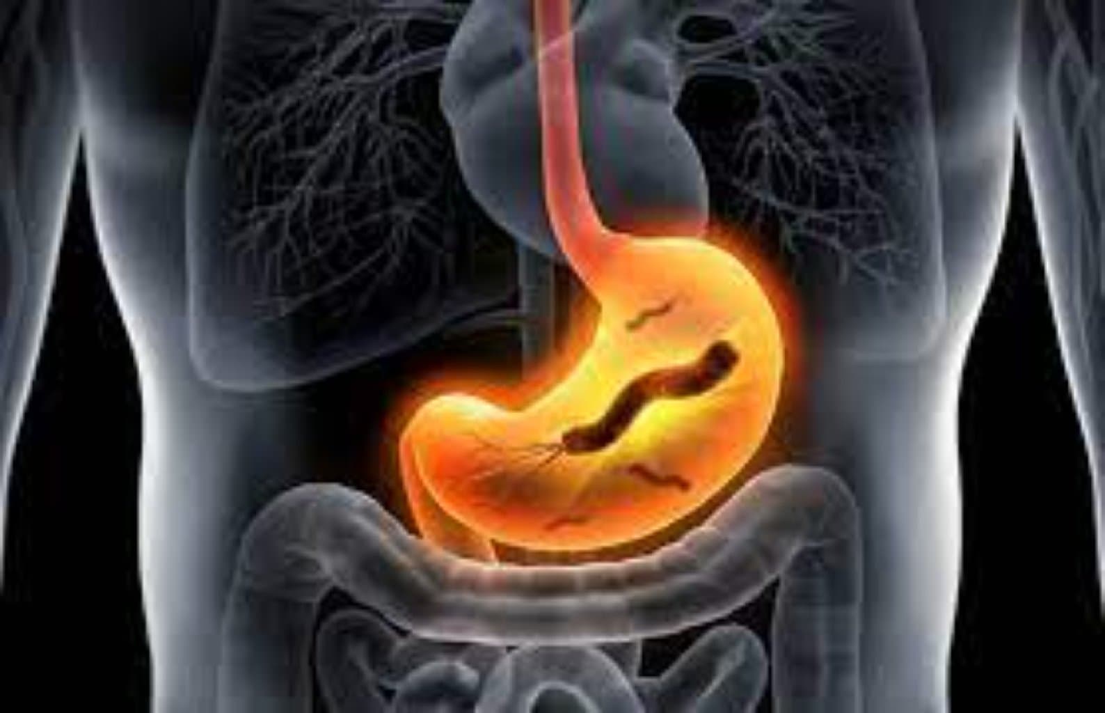 Qələvi Refluks Qastriti (öd qastriti)