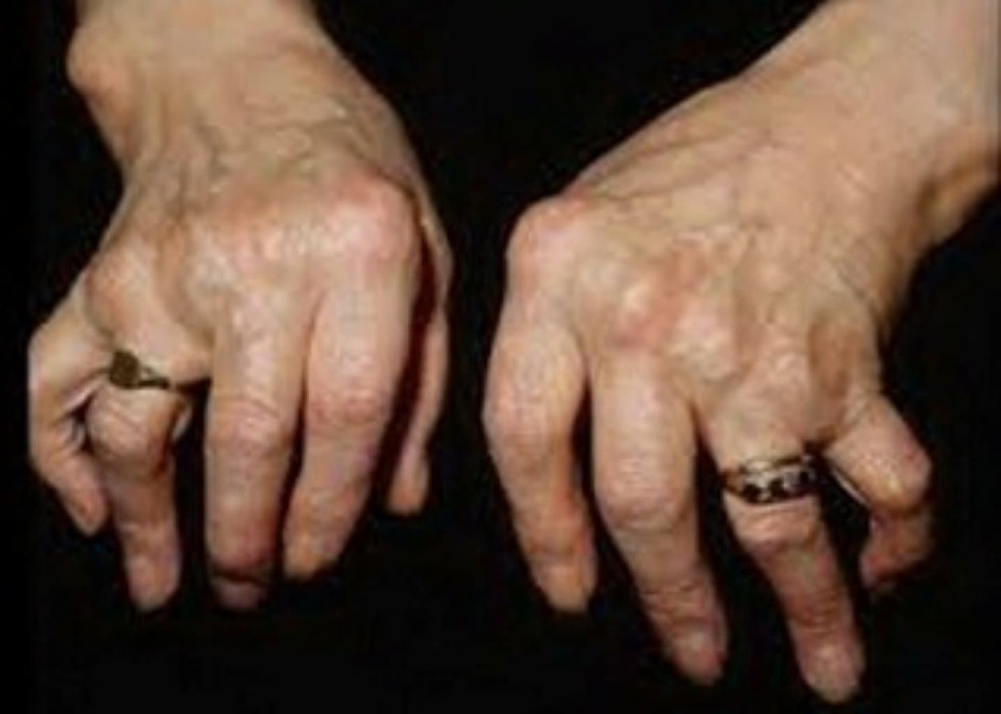 Revmatik Xəstəliklər: Növü, Simptomlar və Müalicə Yolları