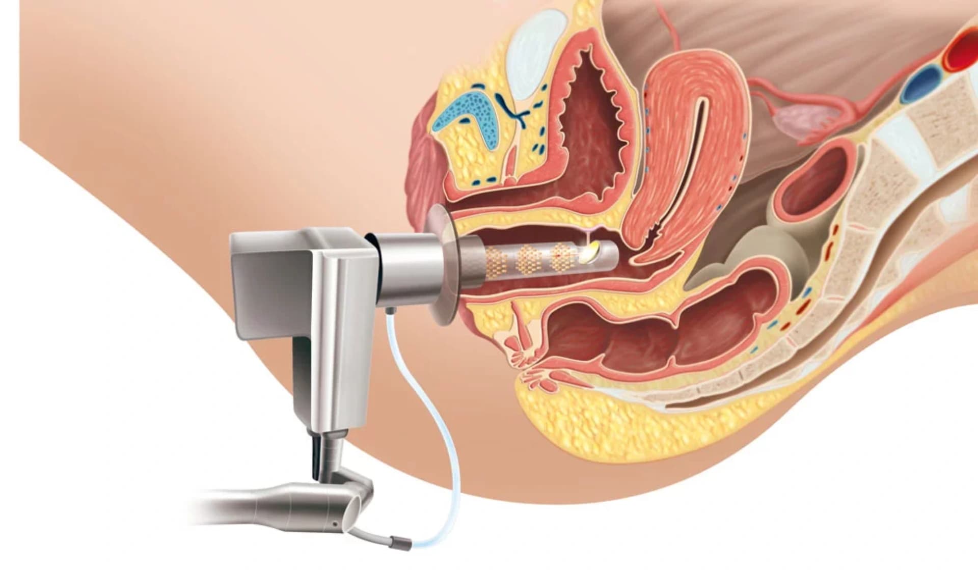 LAZER ÜSULUYLA VAQİNAL CAVANLAŞMA