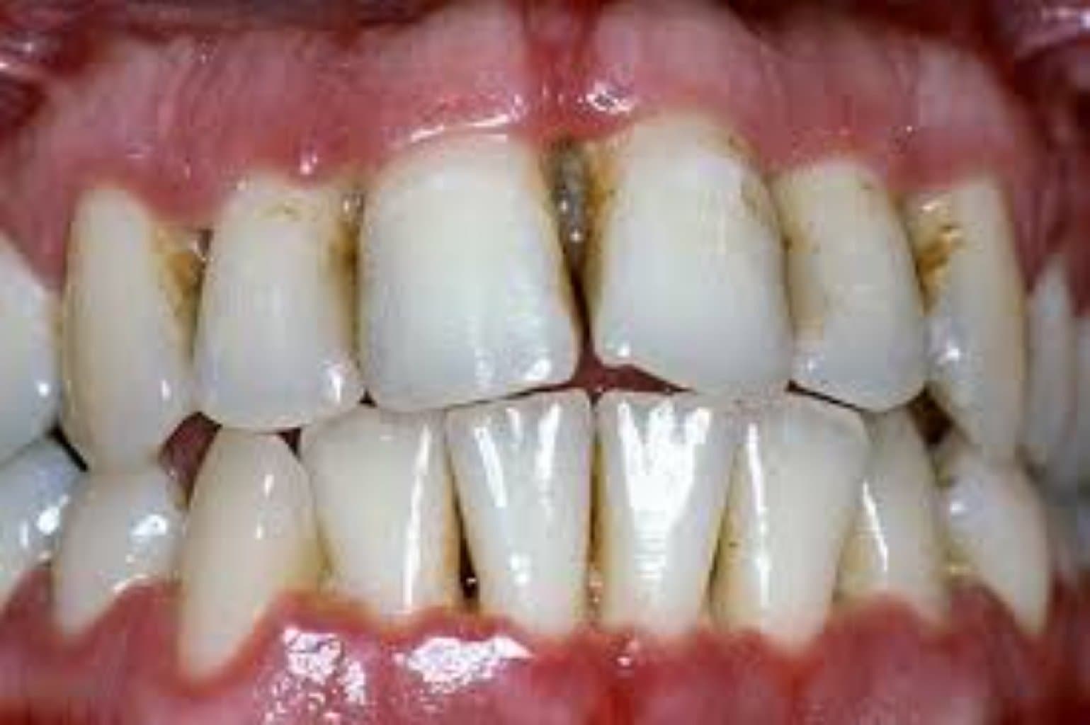 İltihablı dişlərin müalicəsi və s.