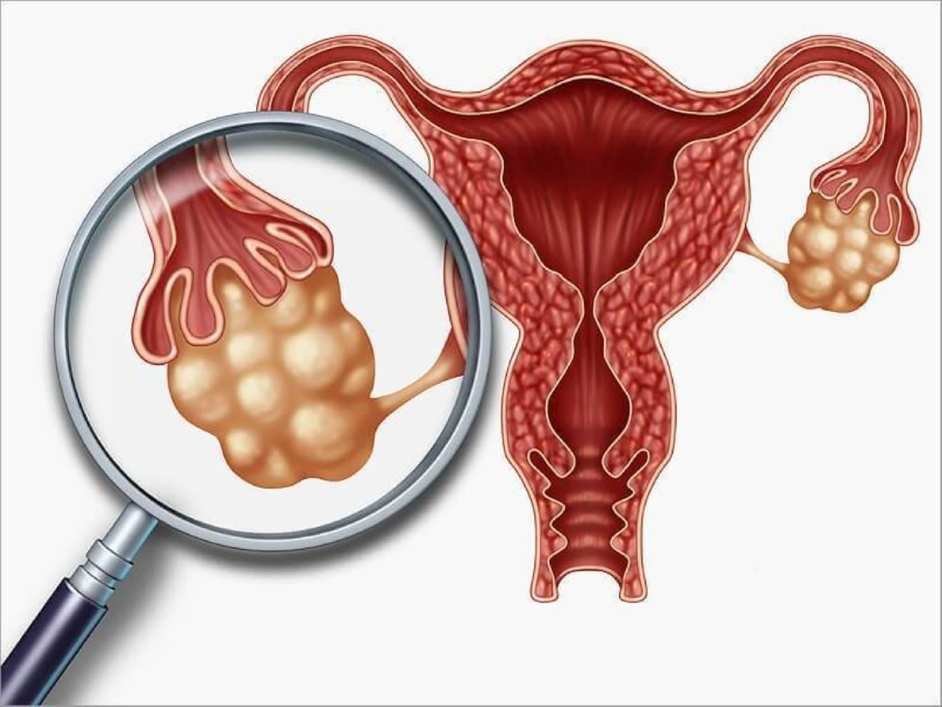 Yumurtalıqlarda baş verən hormonal pozğunluqlar