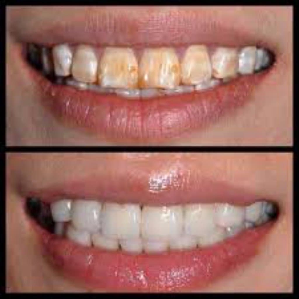 DIŞLƏRIN ESTETIK BƏRPASI