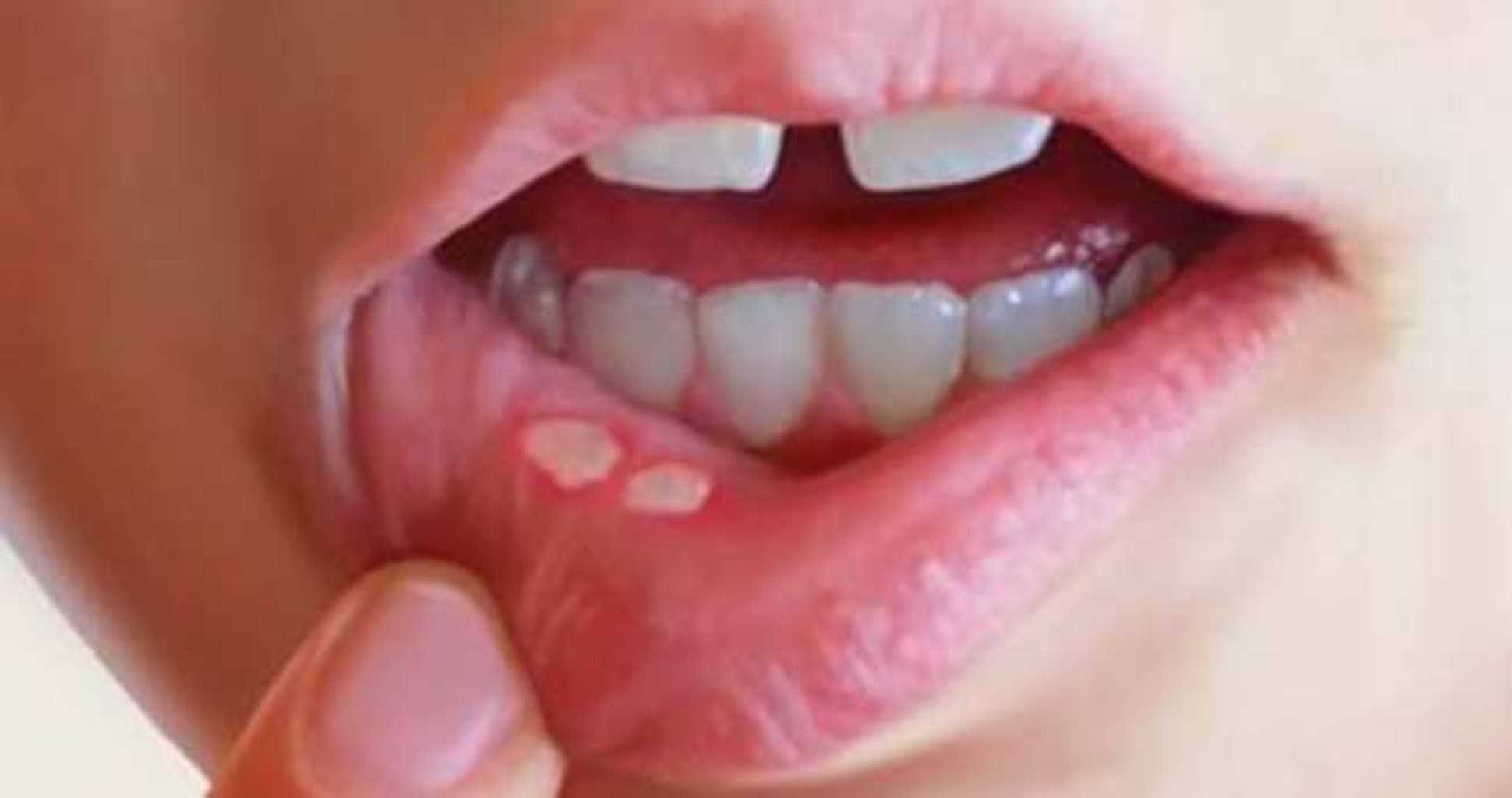 Ağız boşluğunda baş verən göbələk infeksiyaları və onların müalicəsi