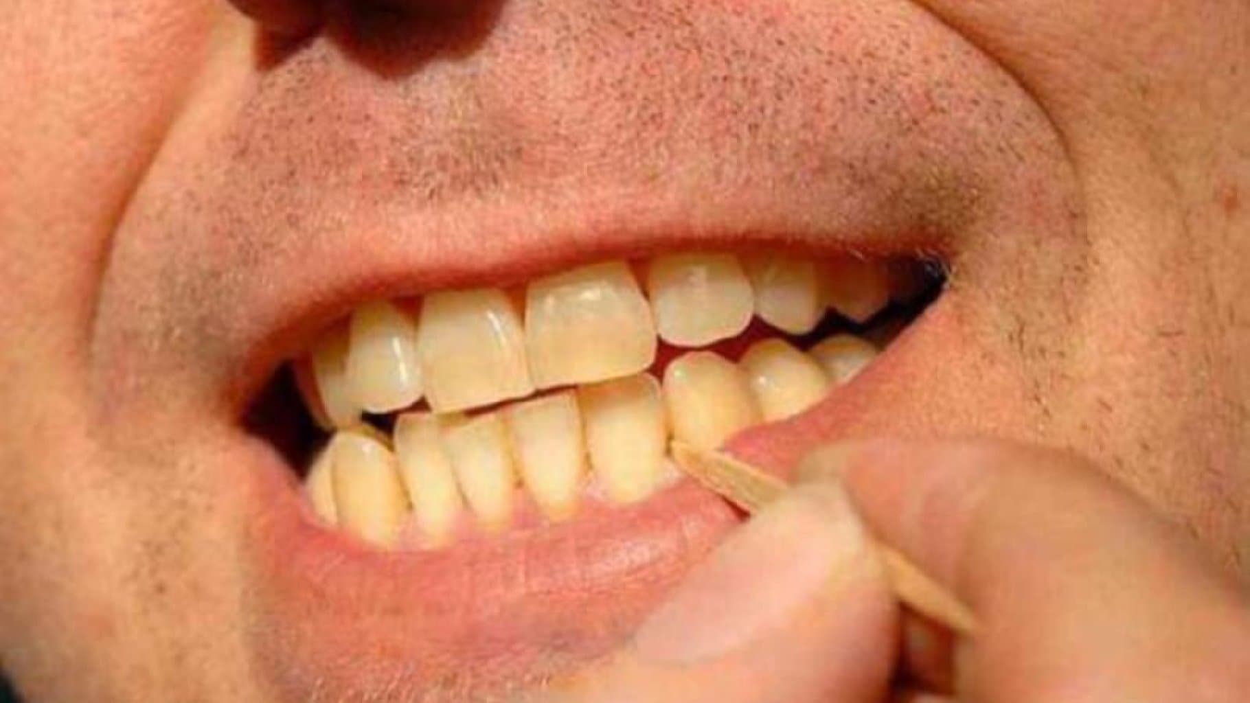 Diş və əti törəmələri: