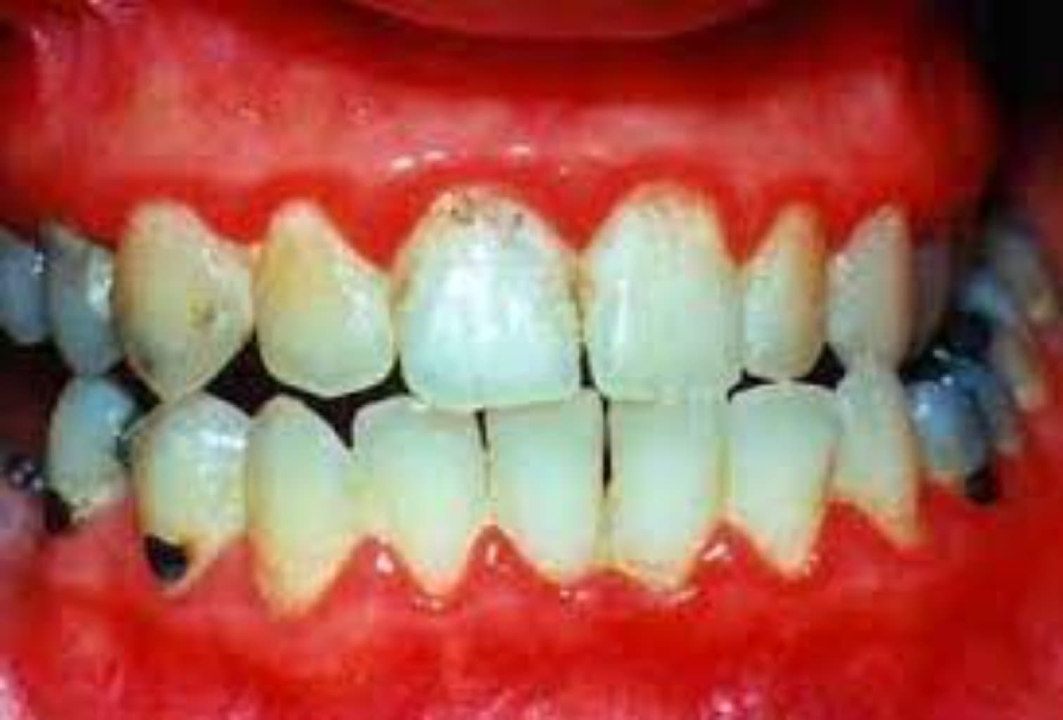 Periodontit (diş əti sərişdən xəstəliyi):