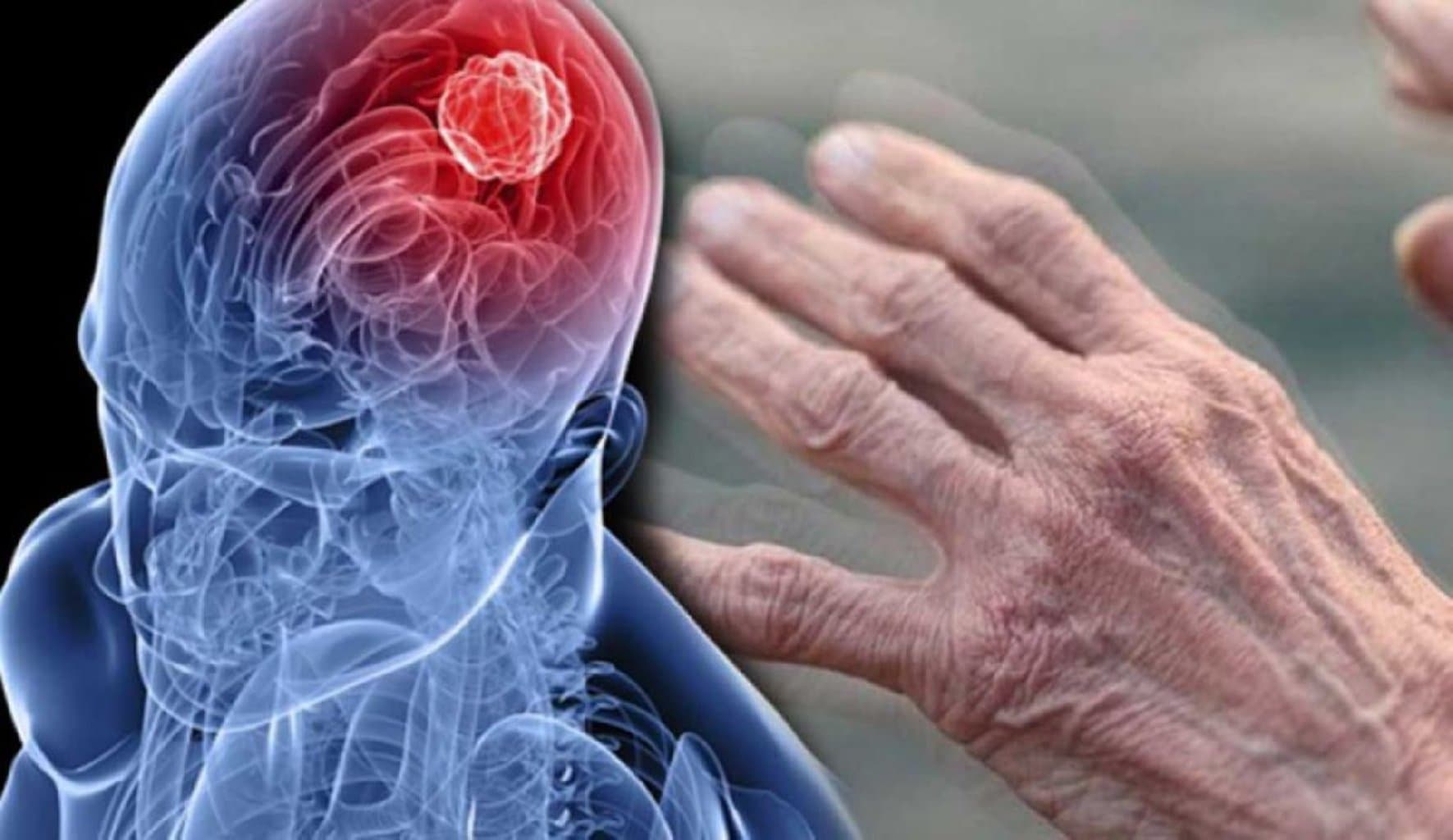 Parkinson Xəstəliyi: Səbəblər, Tanı, və Həyat Üçün İdarə Yolları
