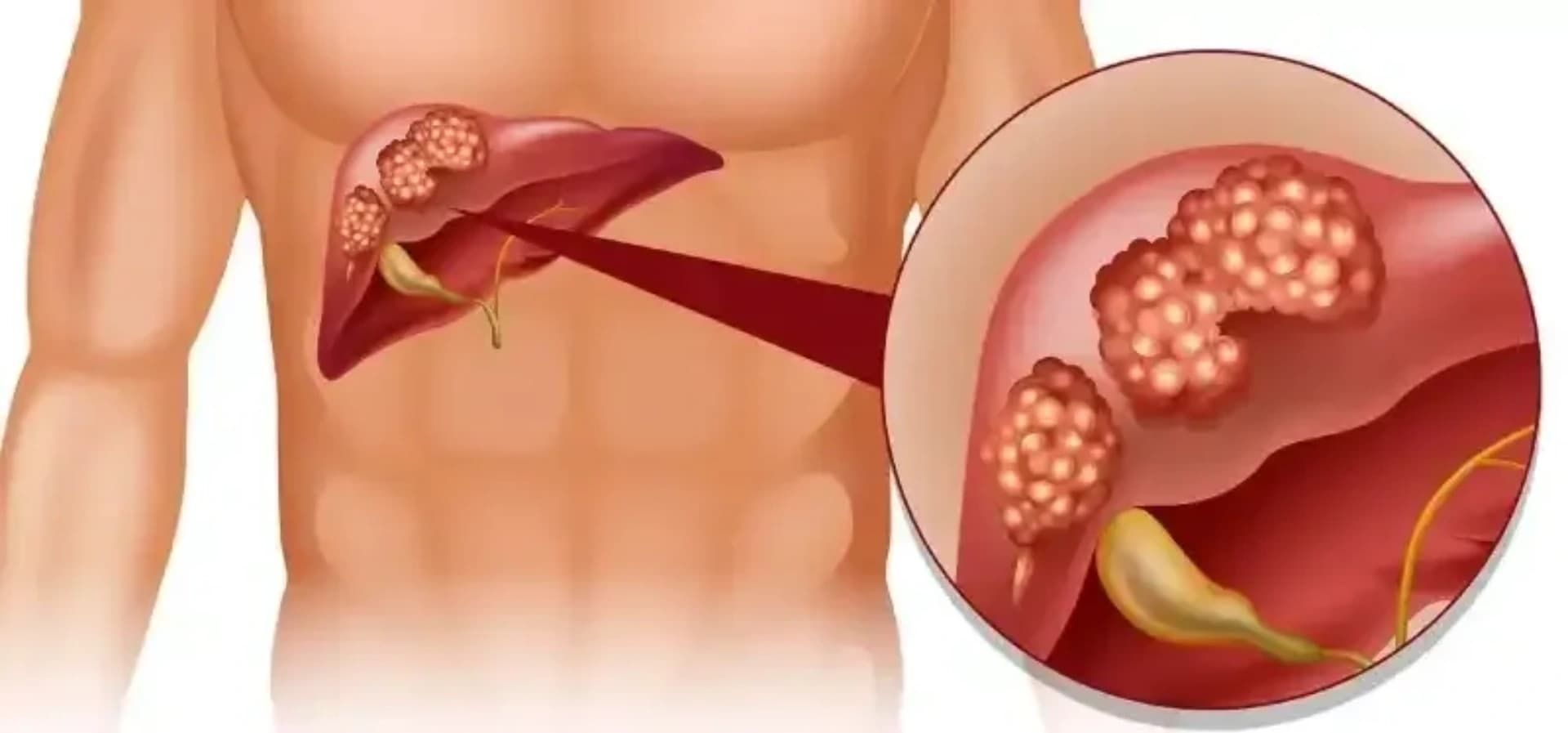 Qaraciyər xərçəngi Növləri