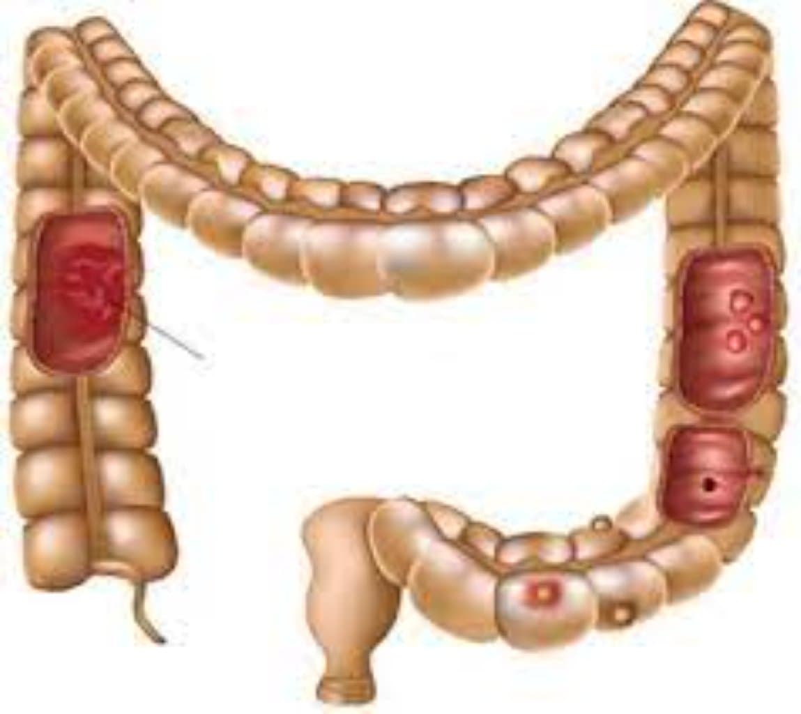 Qeyri-spesifik xoralı kolit