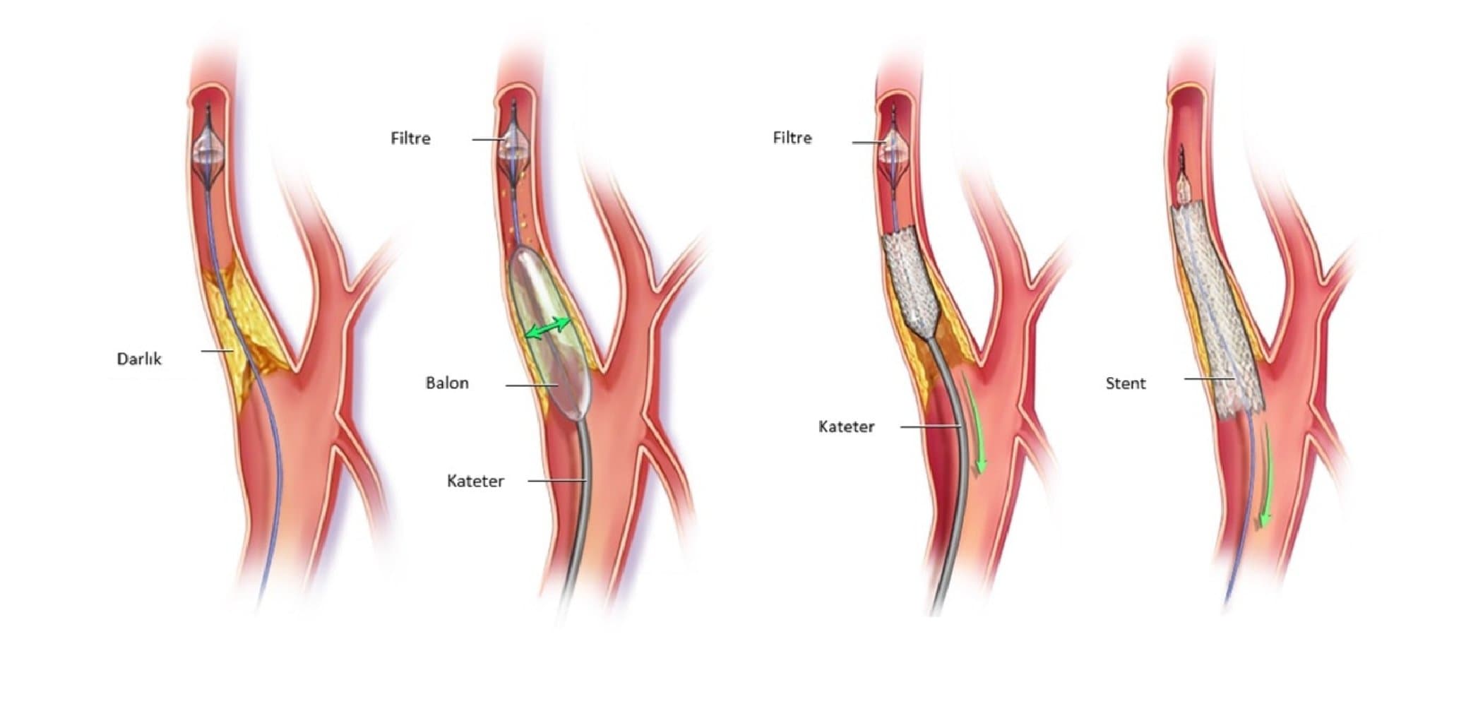 Karotid Stenozu: Tərif, Səbəbləri və Müalicə Yolları