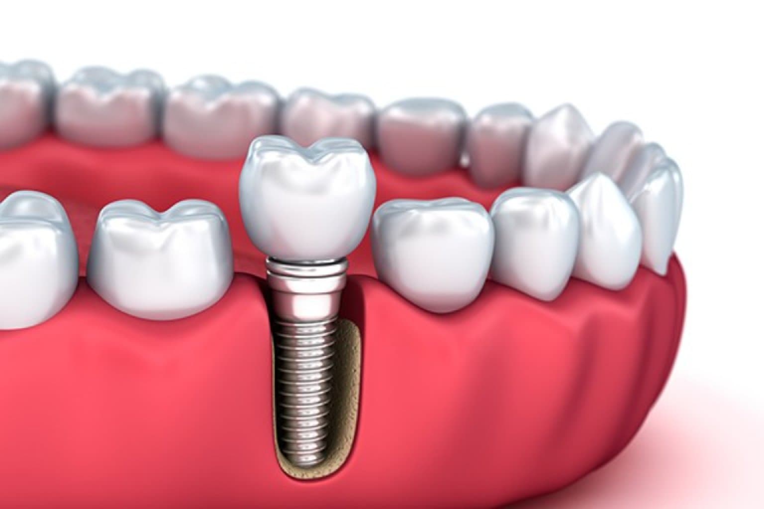İmplantasiya haqqında