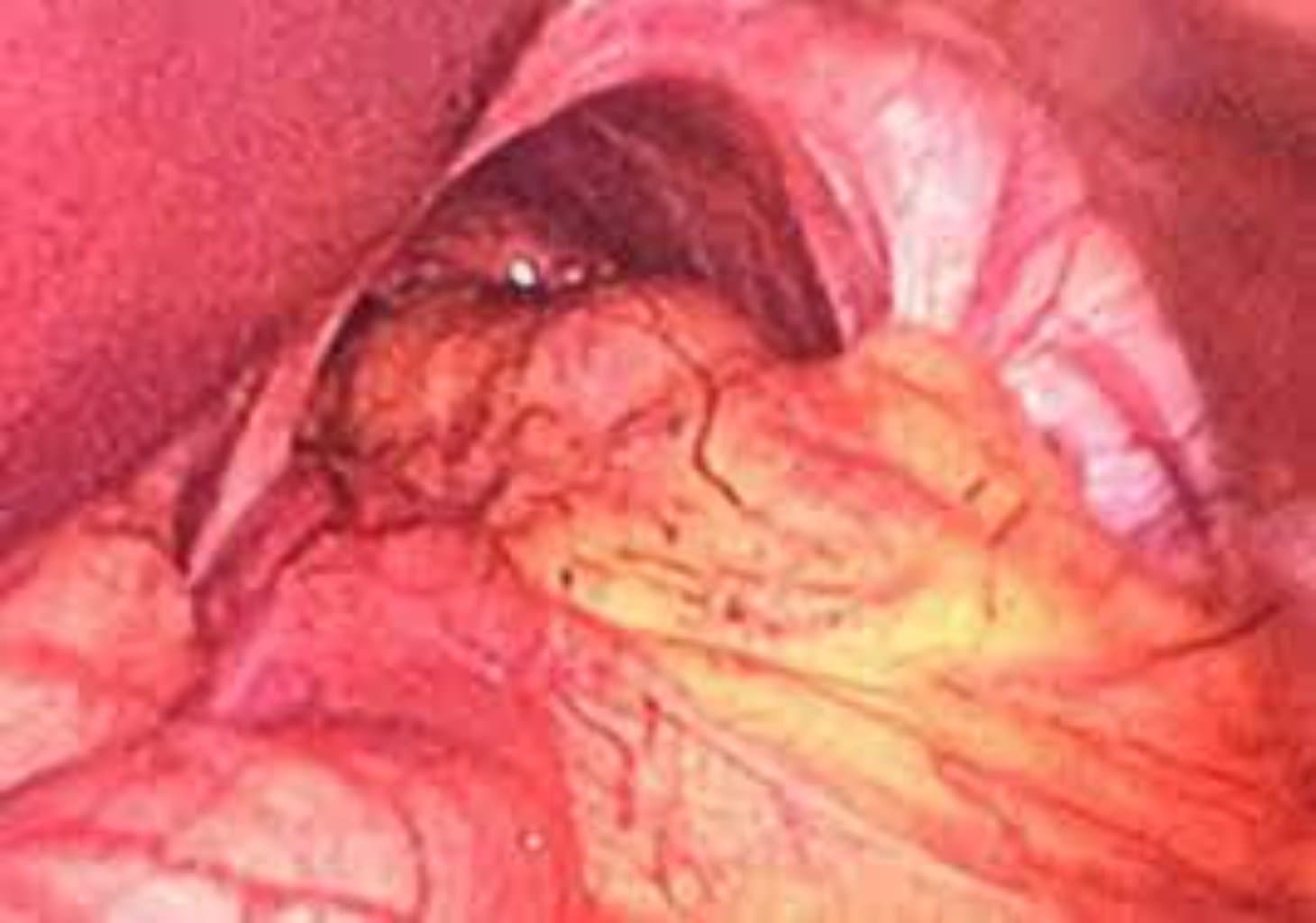 Diaqfraqmal yırtığ