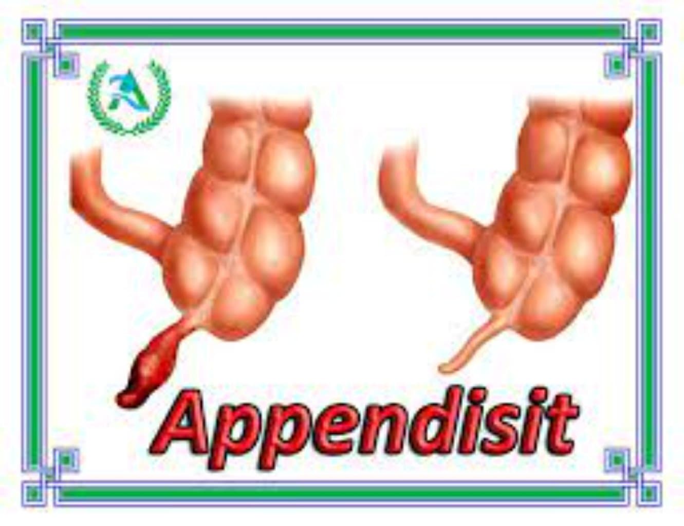 Appendisit
