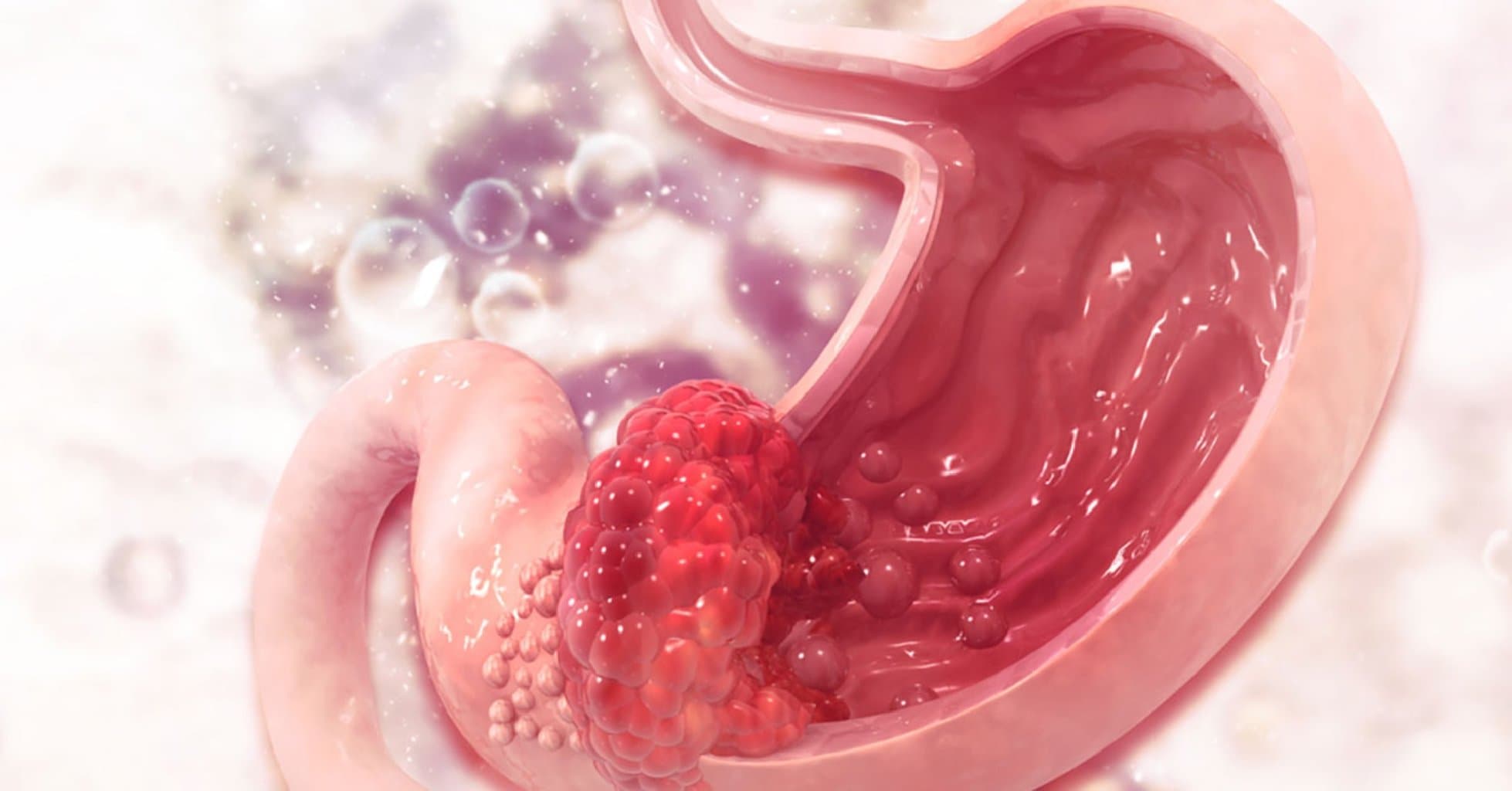 Mədə Xərçəngi: Mədə-bağırsaq Sisteminin Təhlükəli Xəstəliyi