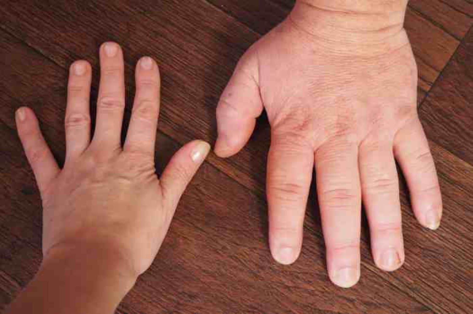 Akromeqaliya xesteliyi haqqında