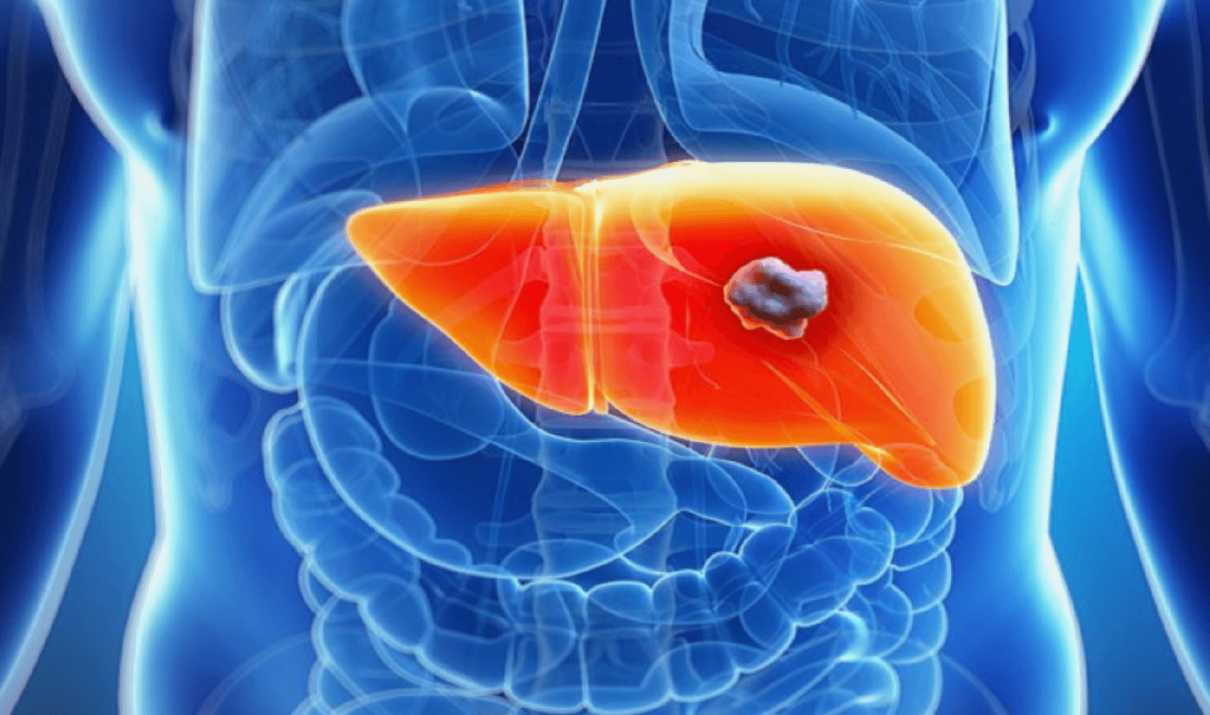 Qaraciyər Xərçəngi