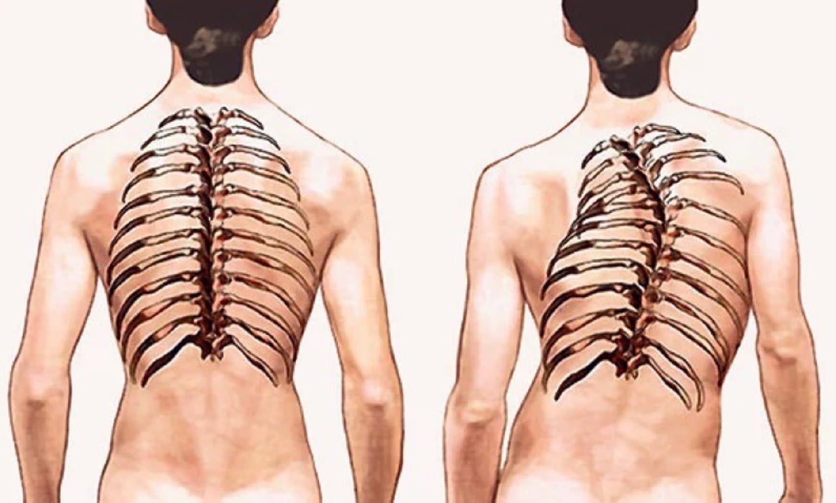 Onurğa sütununun iltihabi xəstəlikləri: simptomlar, diaqnoz və müalicə