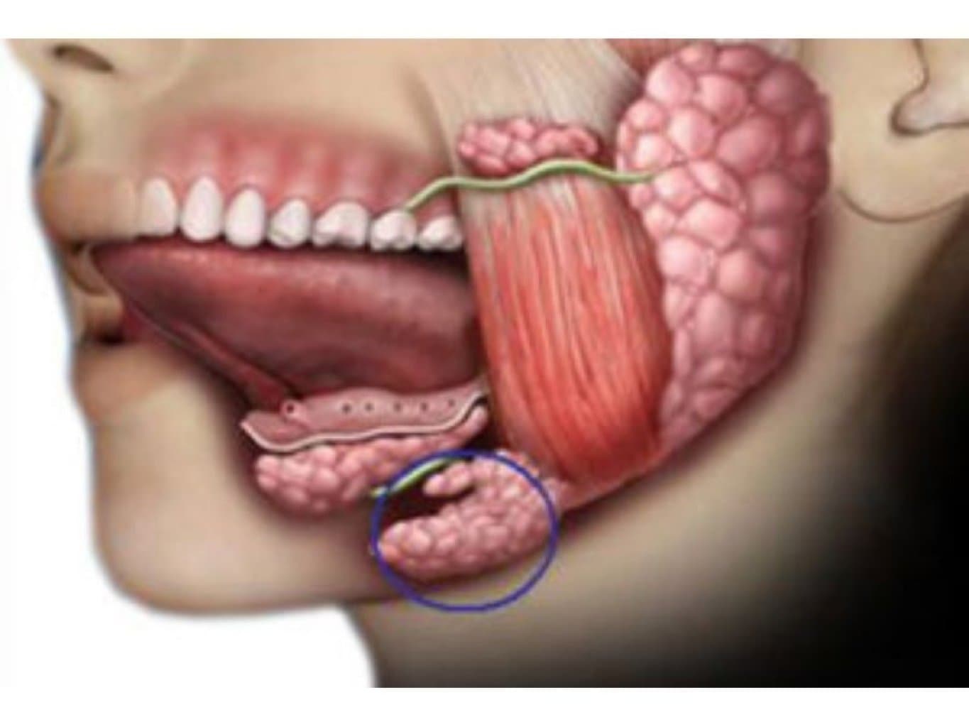 Badamcıq və tüpürcək vəzi xərçəngləri
