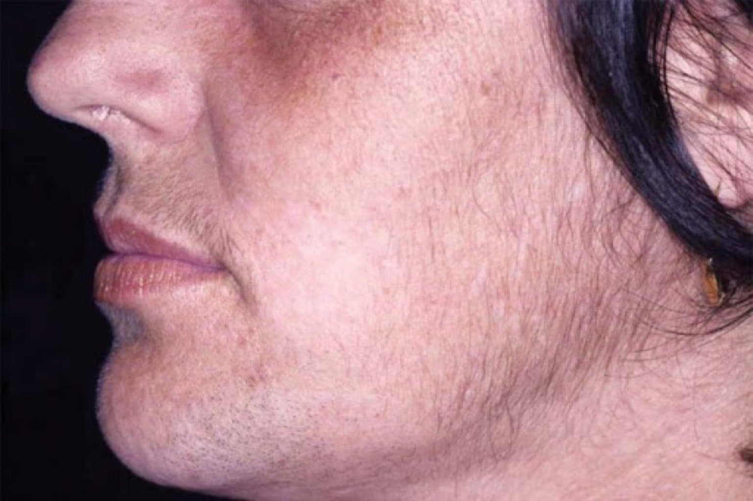 Hirsutizm (tüklənmə)