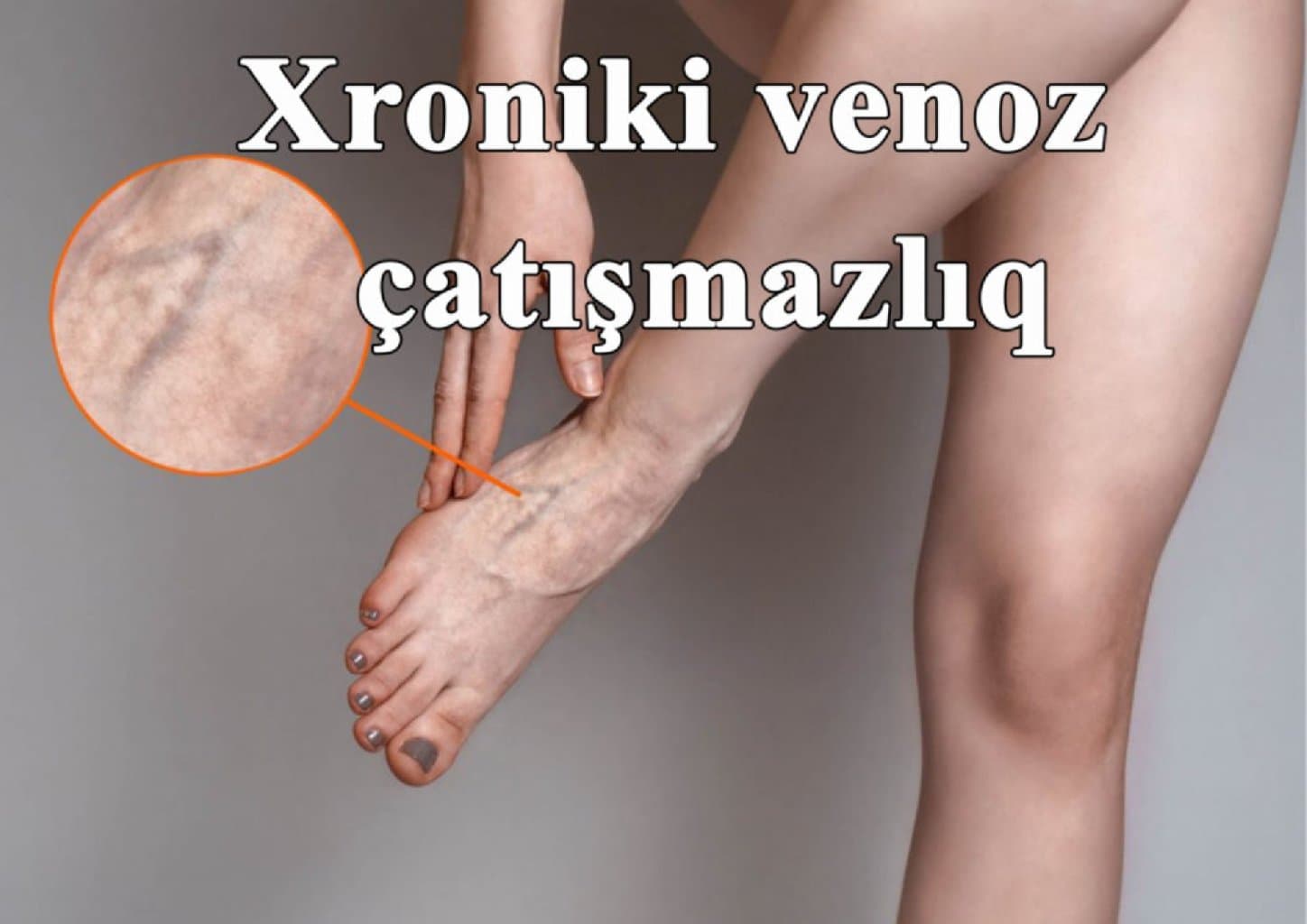 Xroniki venoz çatışmazlıq və ya varikoz damarları nədir?