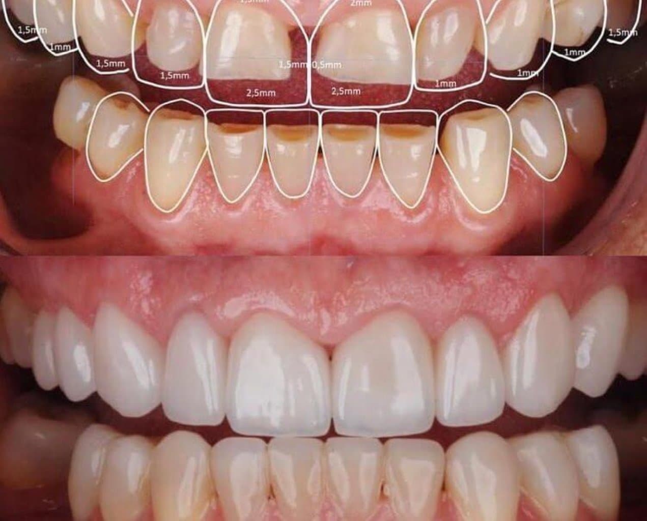 Gülüş Dizaynı: Prosesi, Elementləri və Estetik Stomatolojiyanın Üstünlükləri