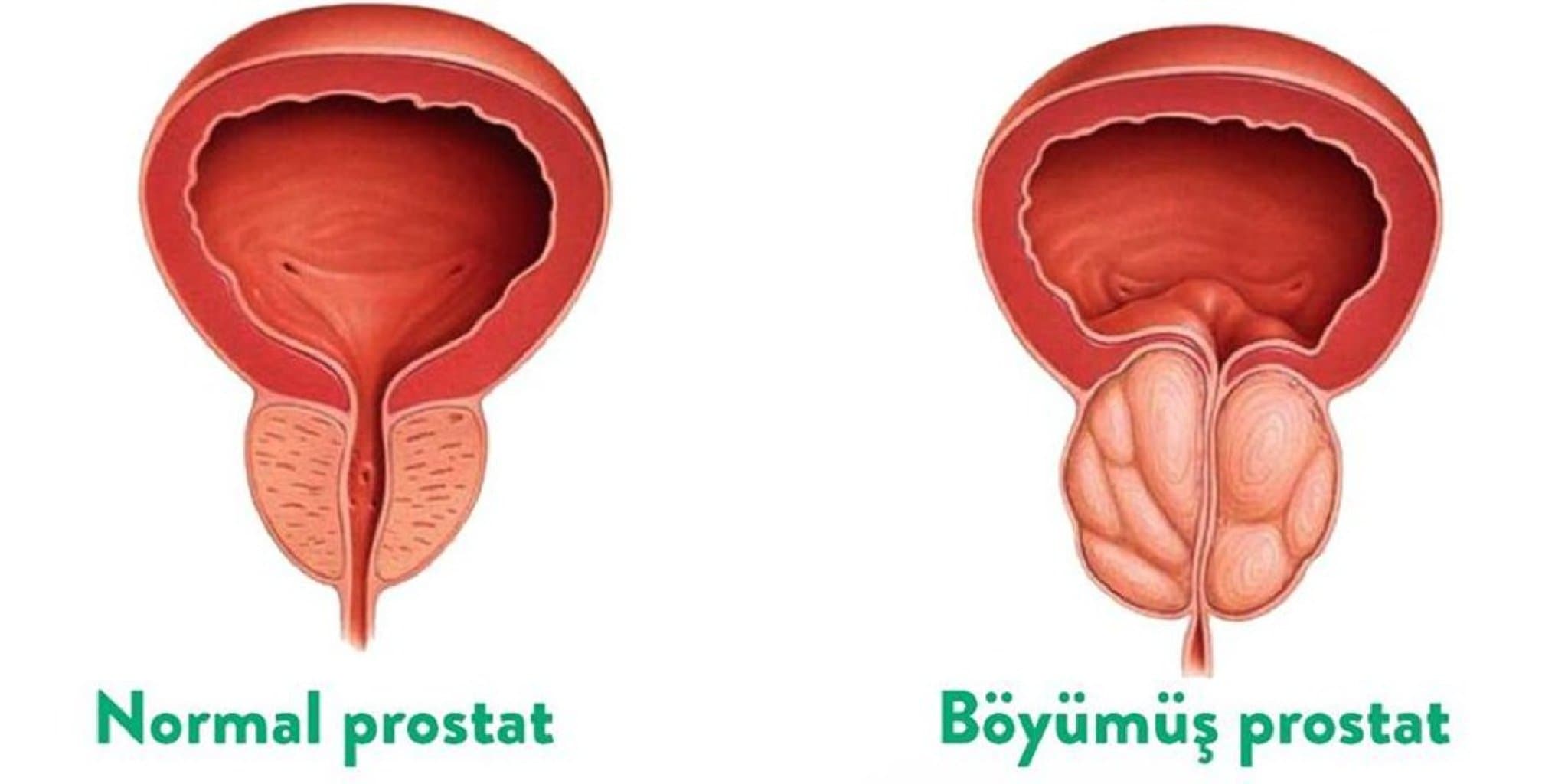 Prostat vezin adenomasi