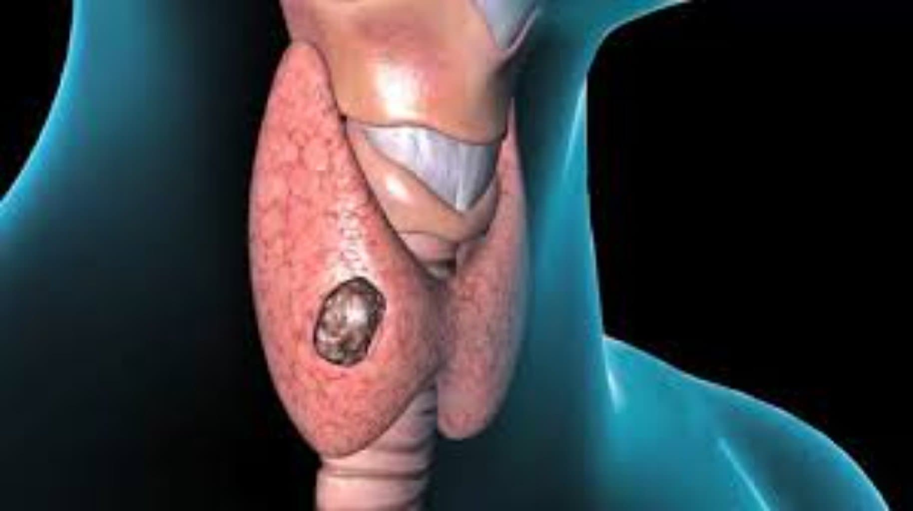 Qalxanabənzər vəz xəstəlikləri