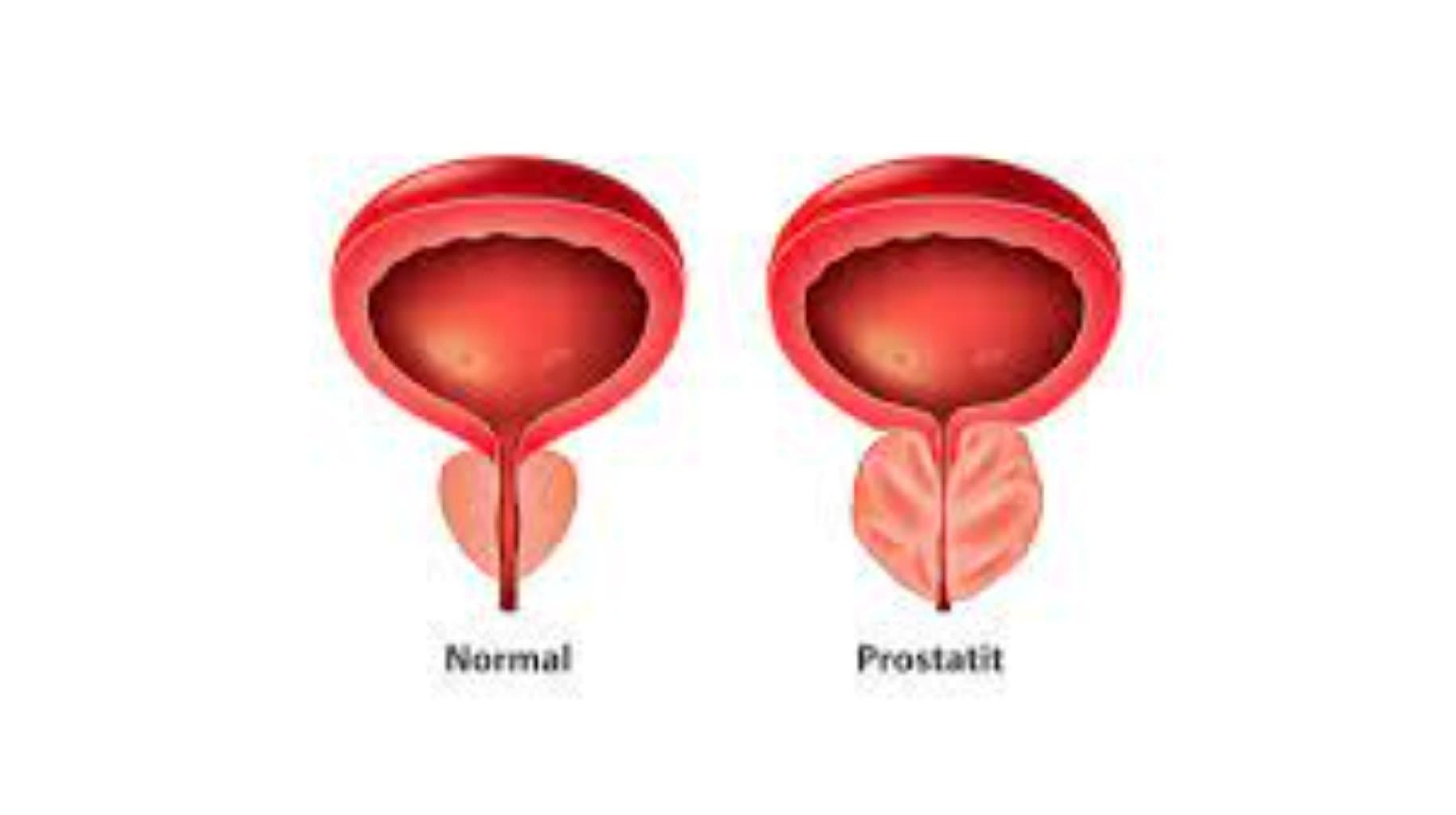 Prostat Vəzinin Böyüməsi: Səbəbləri, Simptomları və Müalicə Yolları