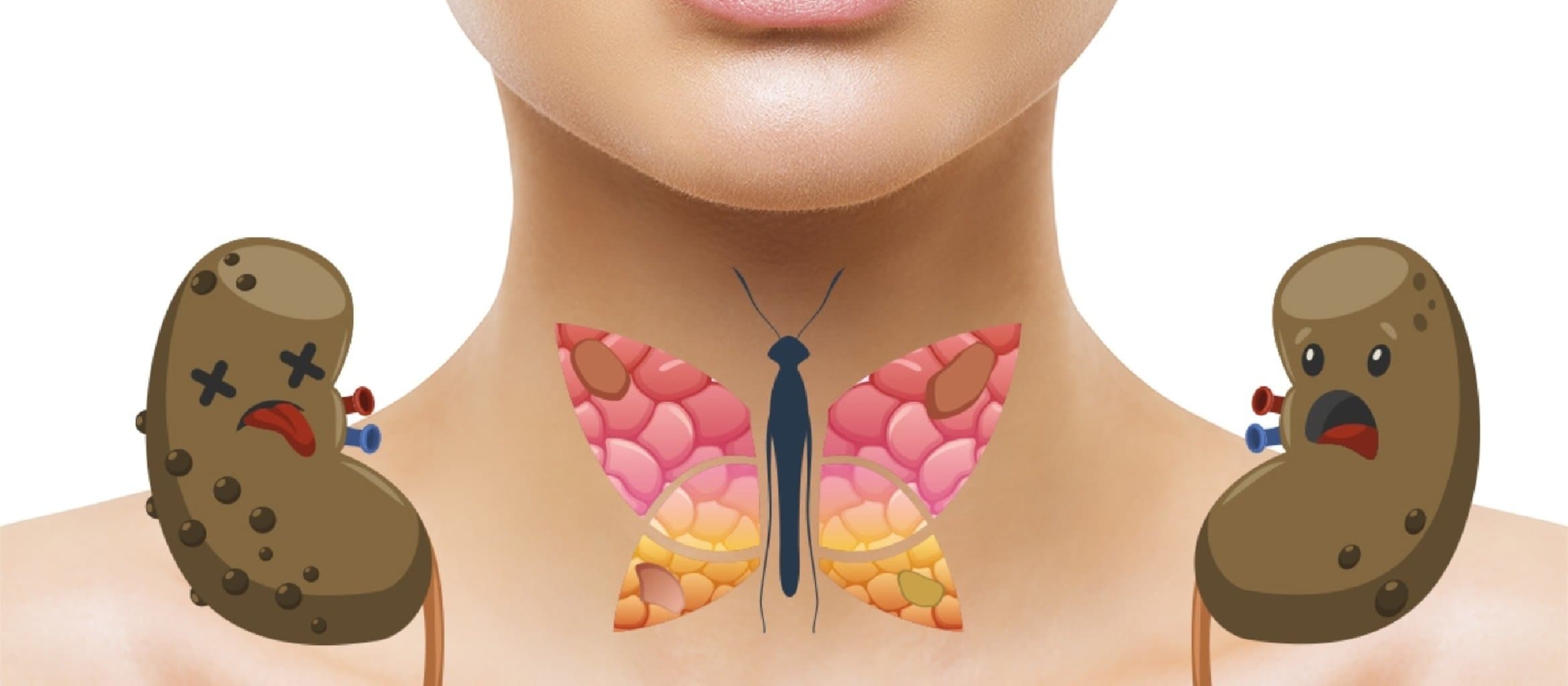 Hiperparatireoz: simptomları, səbəbləri və müalicəsi