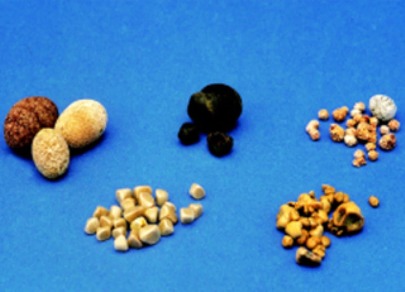 Öd kisəsi daşları