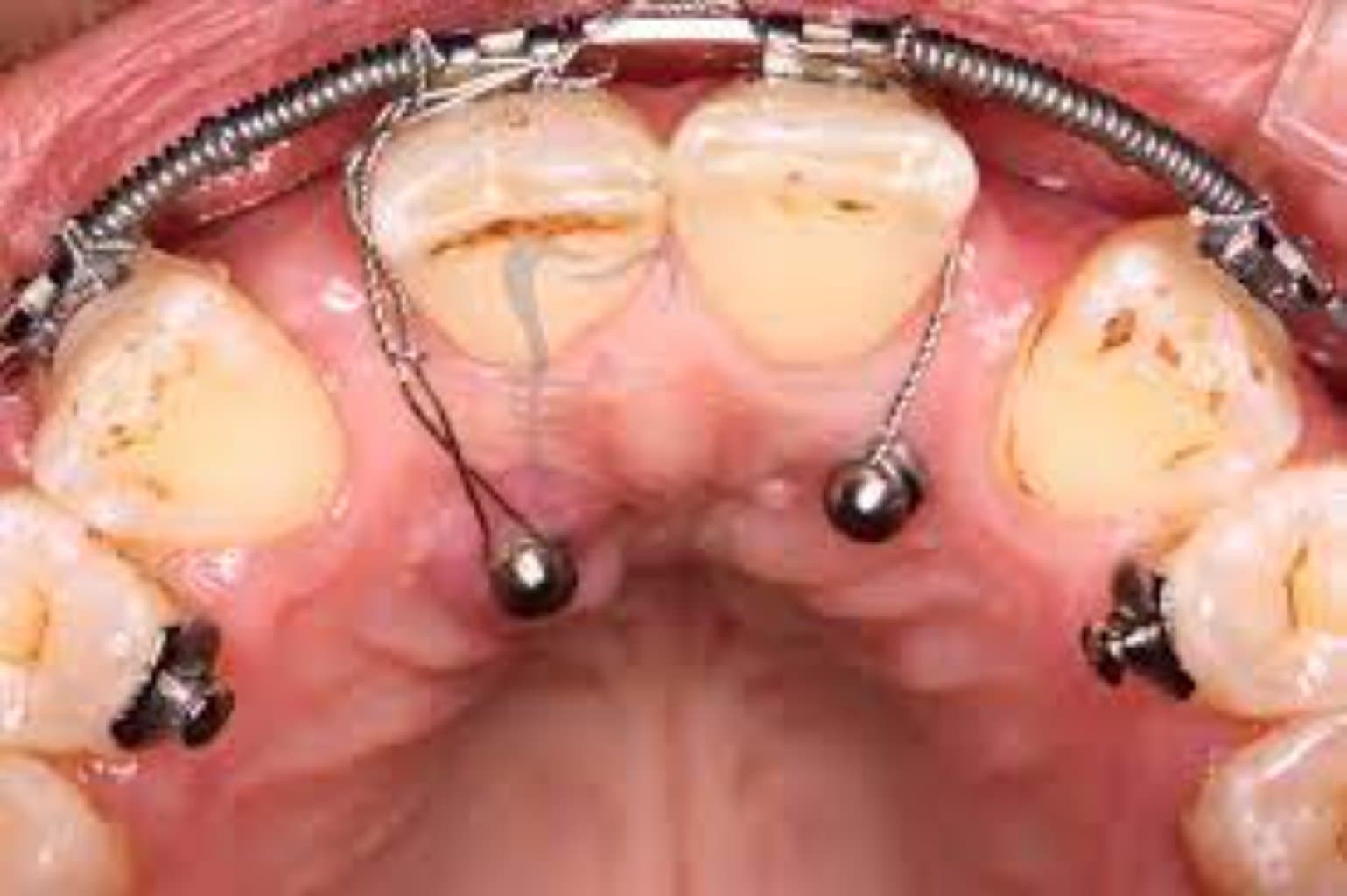 Müxtəlif növ işıqlı kompozit plomblar