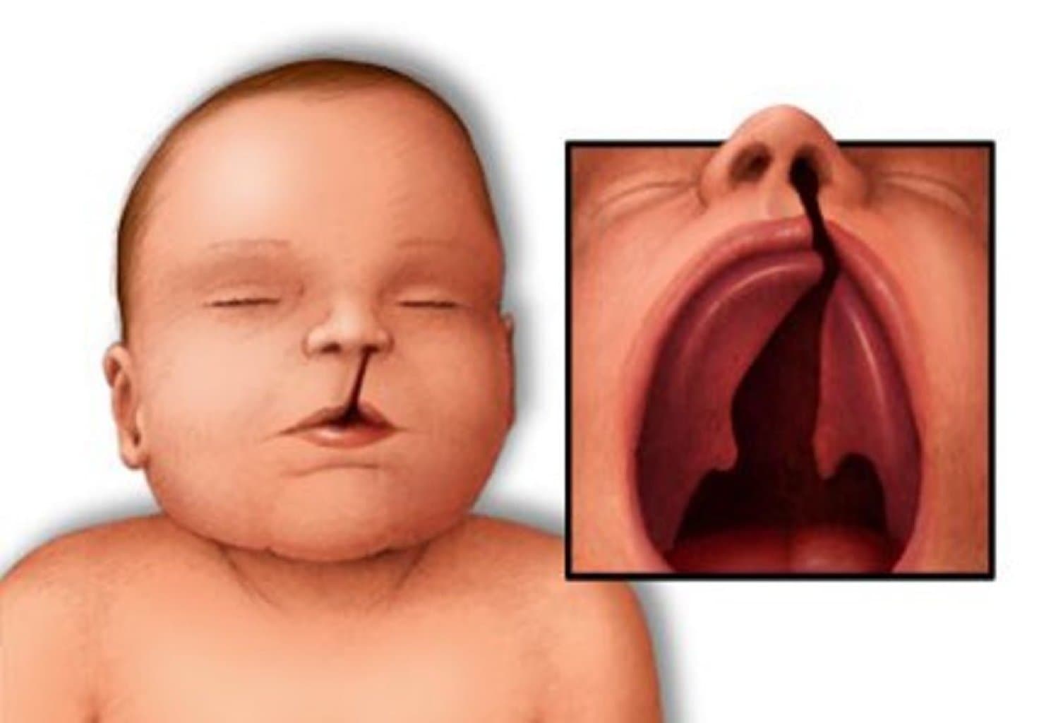 Yarıq dodaq damağı