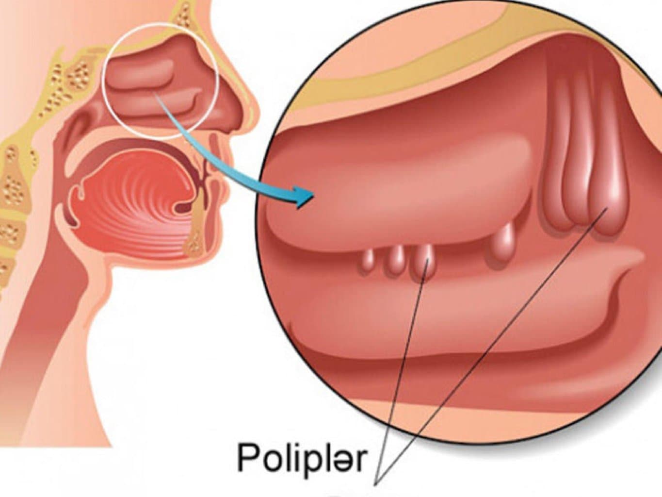 Burun Polipləri nədir?