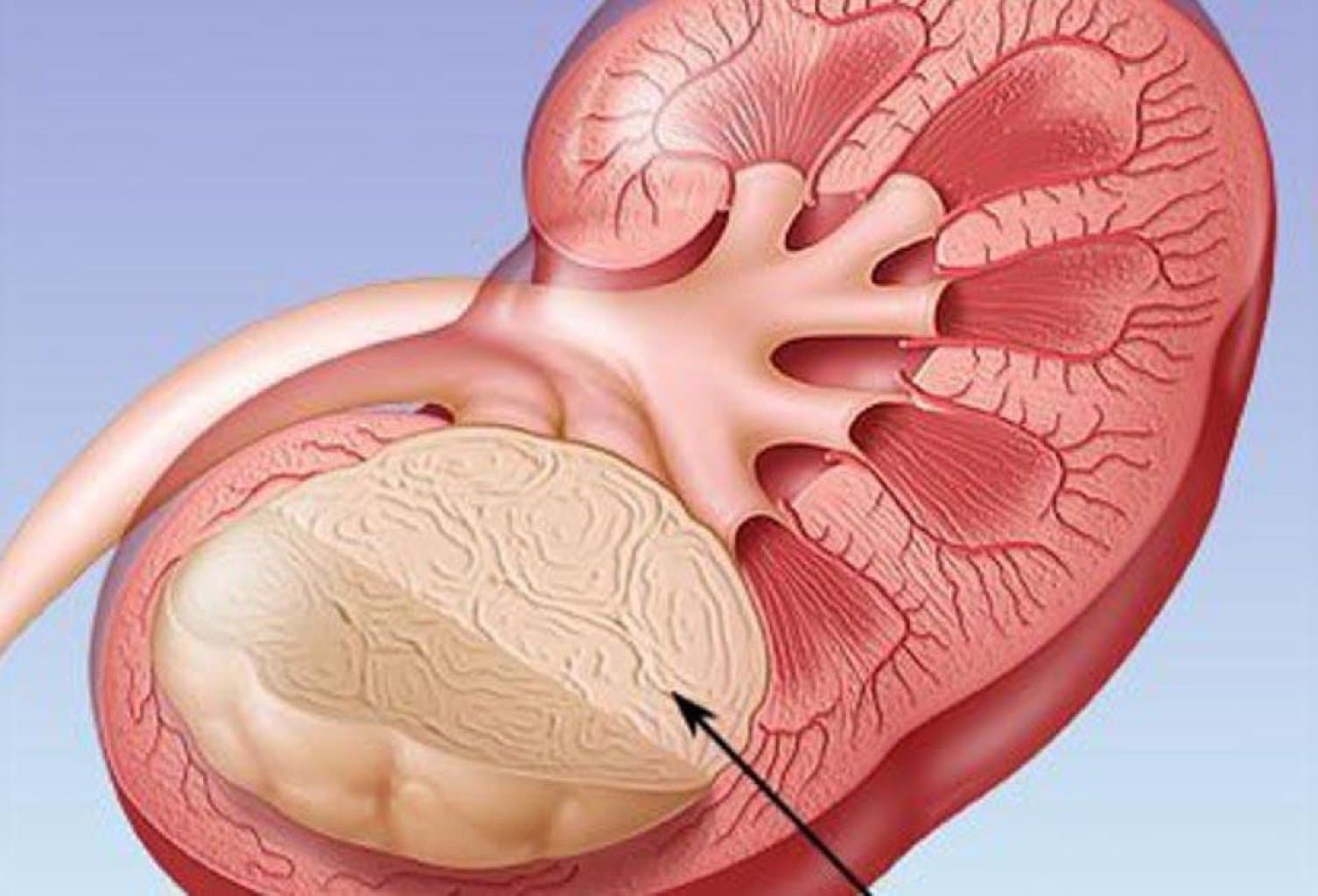 Böyrək şişinin müalicəsi necə olmalıdır?