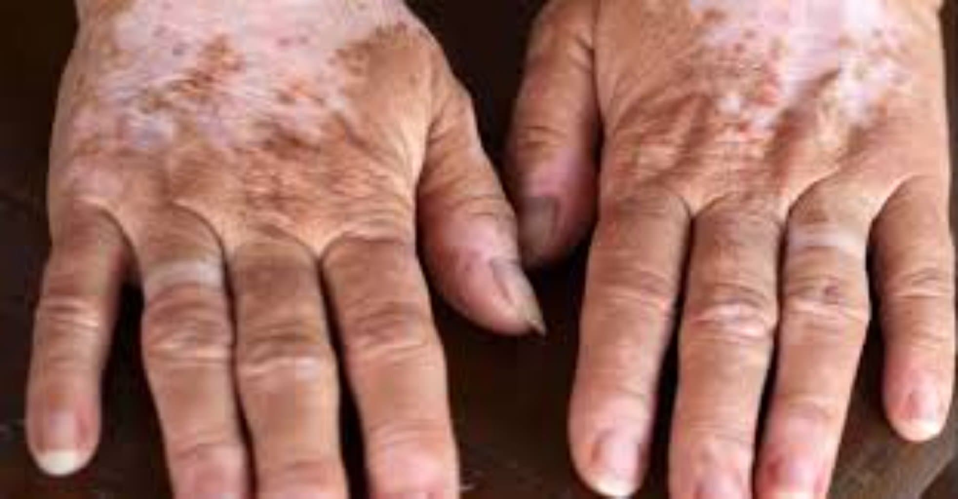 Addison xəstəliyi: simptomlar, səbəblər və müalicə